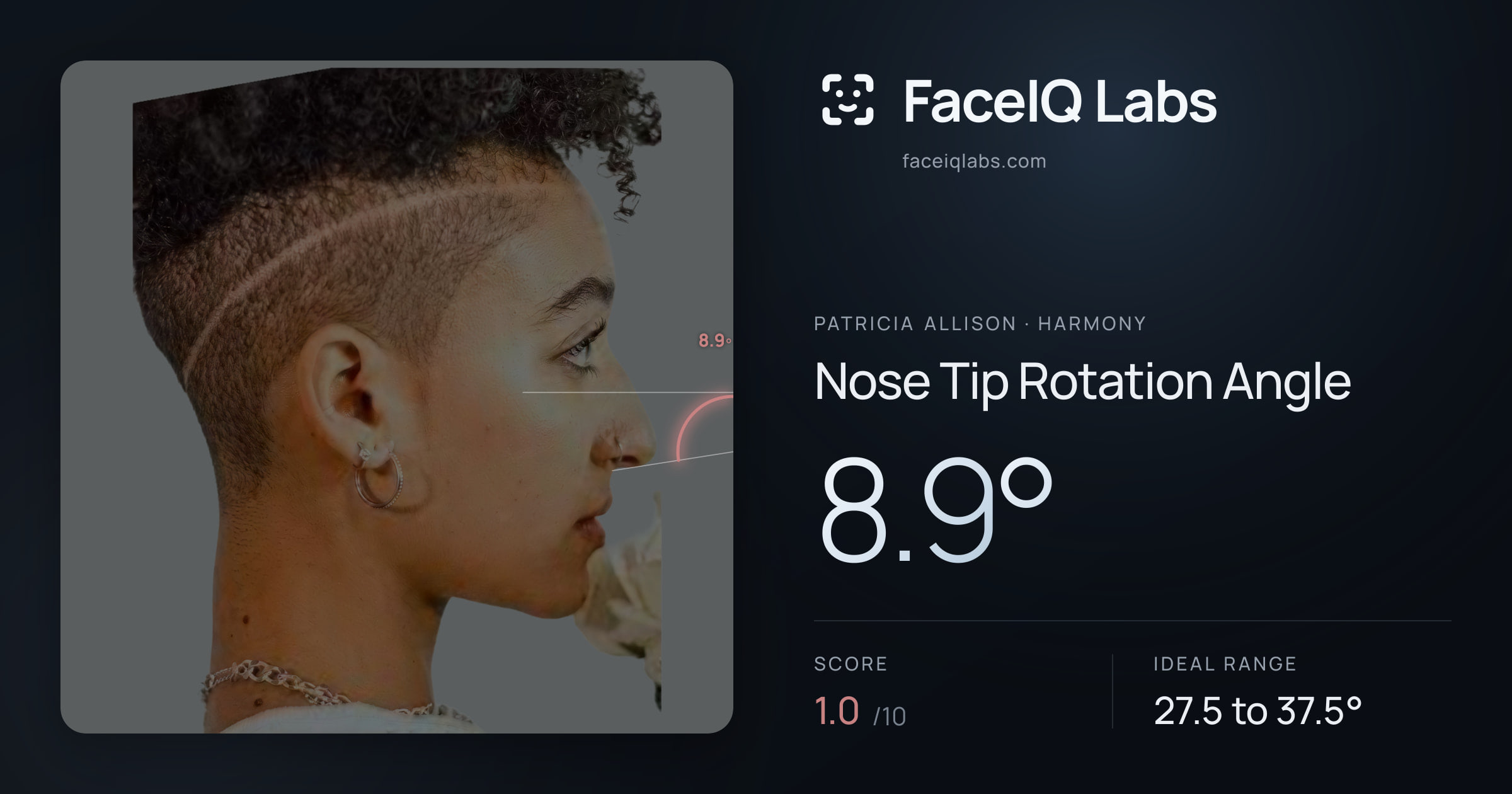 Patricia Allison Nose Tip Rotation Angle: 8.9°, drawn on the photo