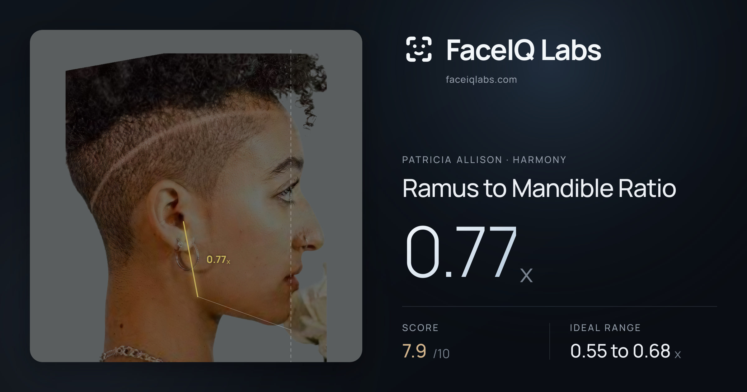Patricia Allison Ramus to Mandible Ratio: 0.77x, drawn on the photo