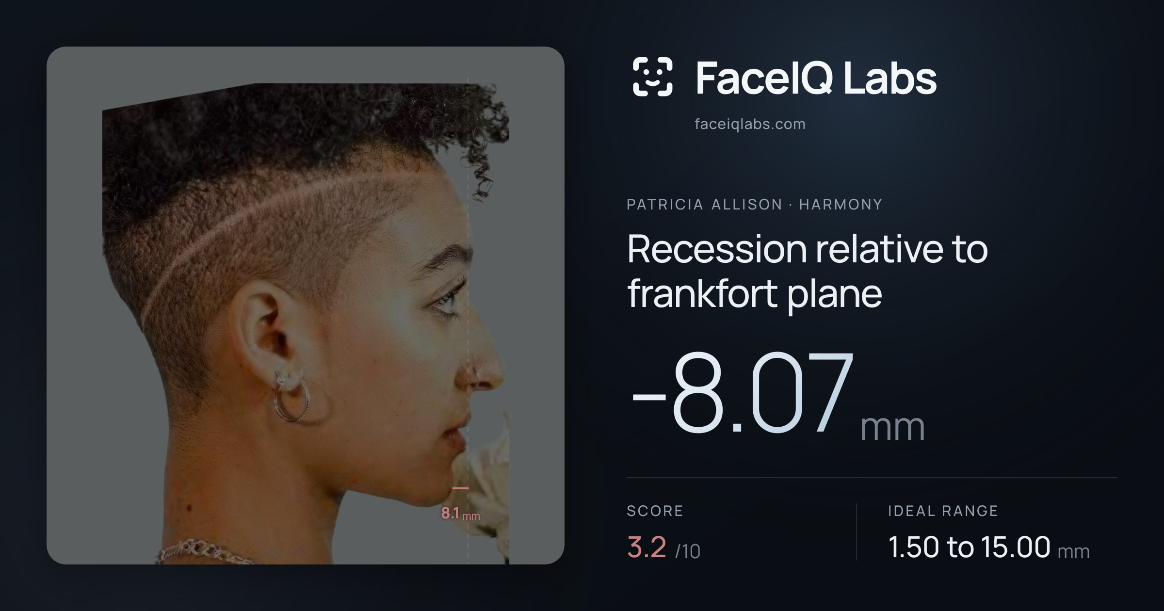 Patricia Allison Recession relative to frankfort plane: -8.07mm, drawn on the photo