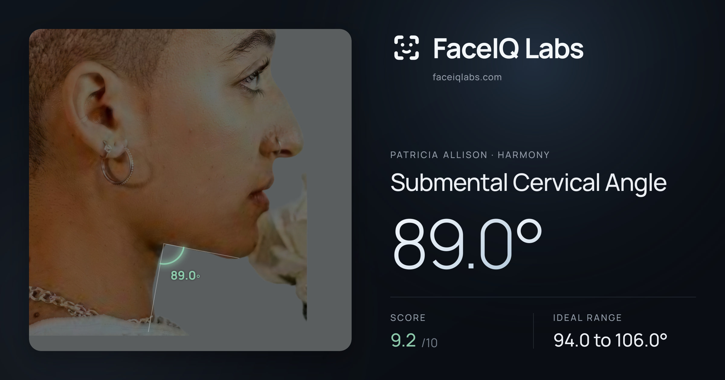 Patricia Allison Submental Cervical Angle: 89.0°, drawn on the photo