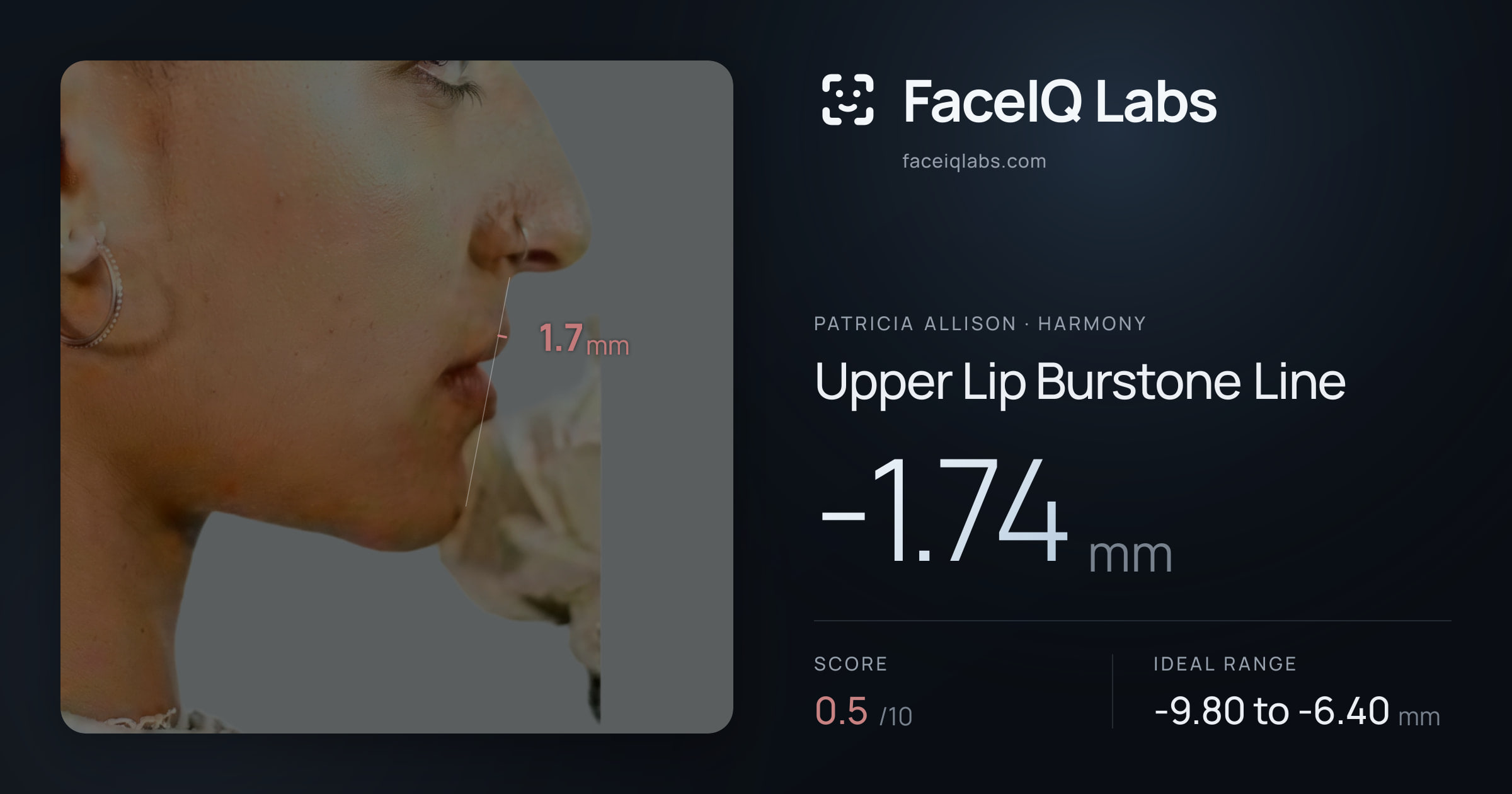 Patricia Allison Upper Lip Burstone Line: -1.74mm, drawn on the photo
