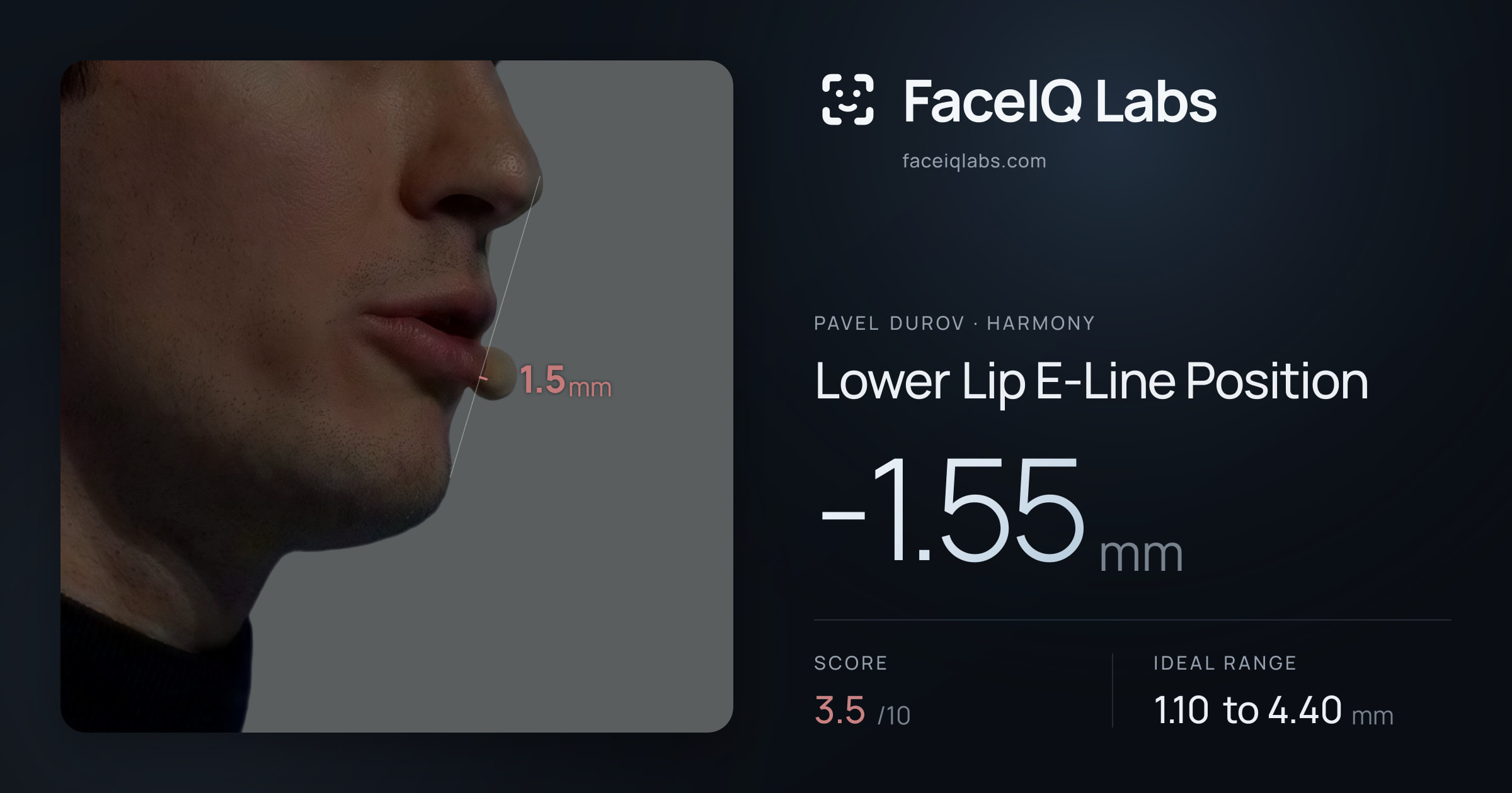 Pavel Durov Lower Lip E-Line Position: -1.55mm, drawn on the photo