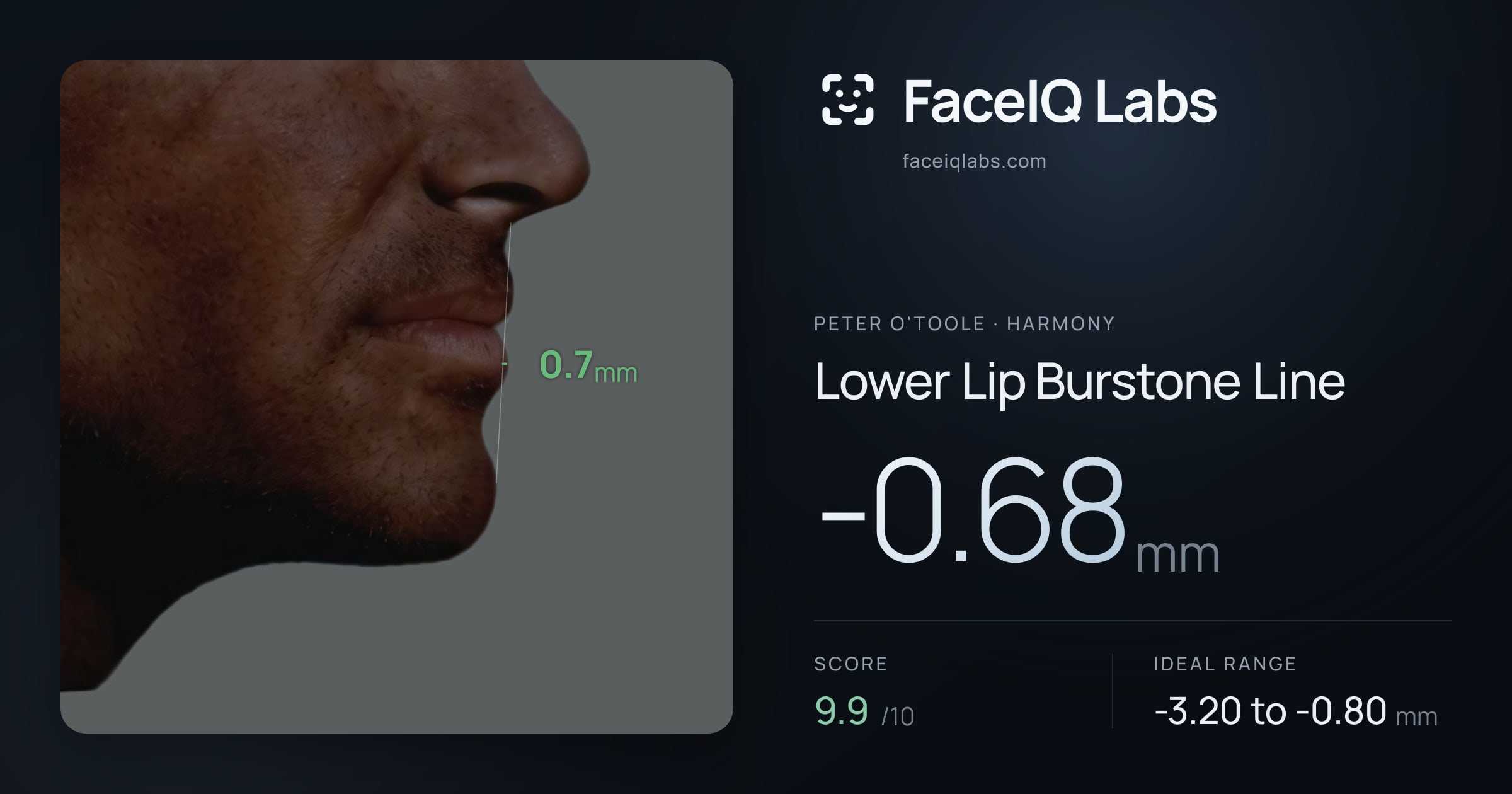 Peter O'Toole Lower Lip Burstone Line: -0.68mm, drawn on the photo