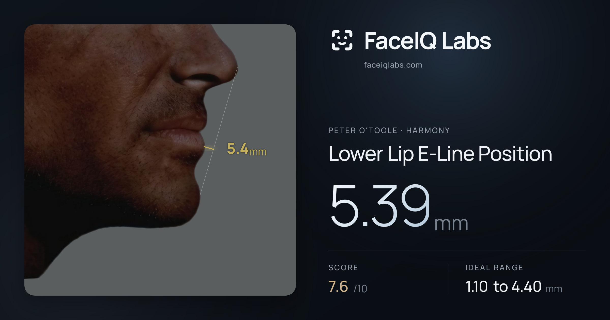 Peter O'Toole Lower Lip E-Line Position: 5.39mm, drawn on the photo