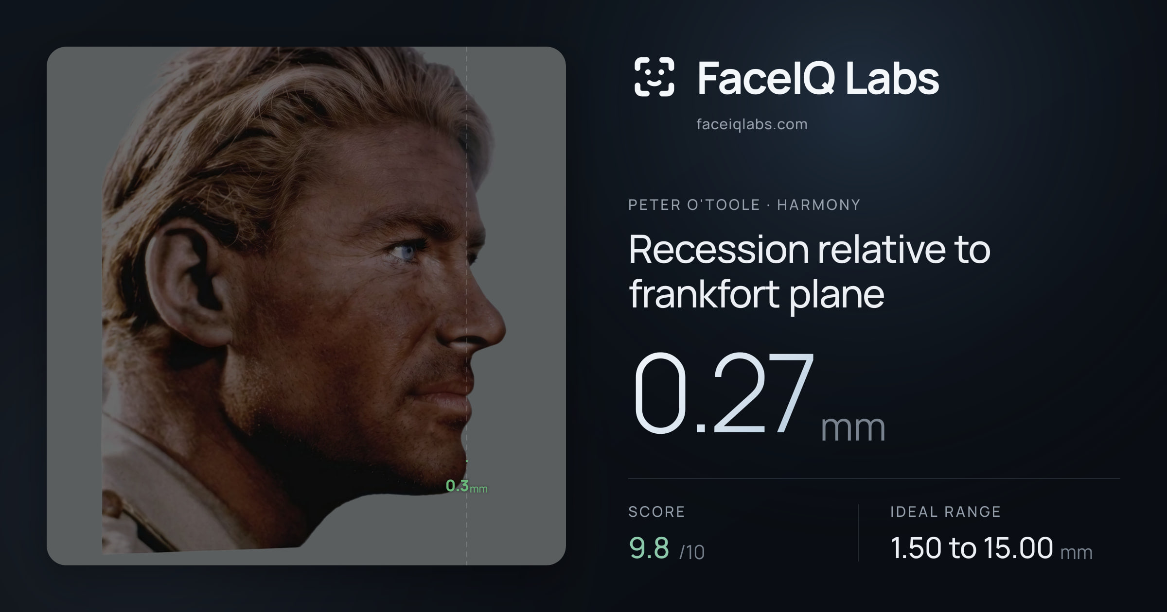 Peter O'Toole Recession relative to frankfort plane: 0.27mm, drawn on the photo