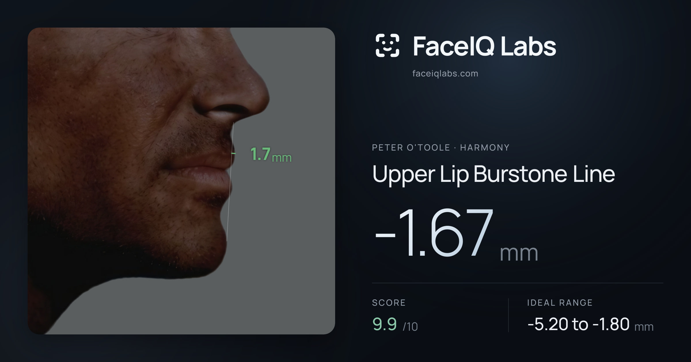 Peter O'Toole Upper Lip Burstone Line: -1.67mm, drawn on the photo