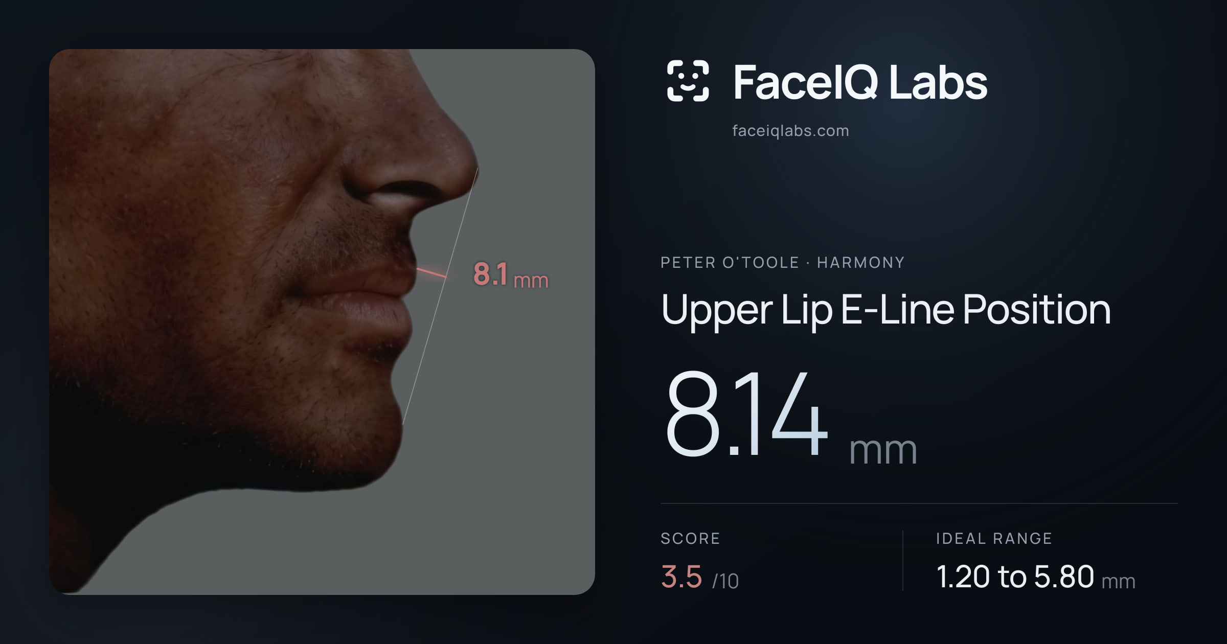 Peter O'Toole Upper Lip E-Line Position: 8.14mm, drawn on the photo