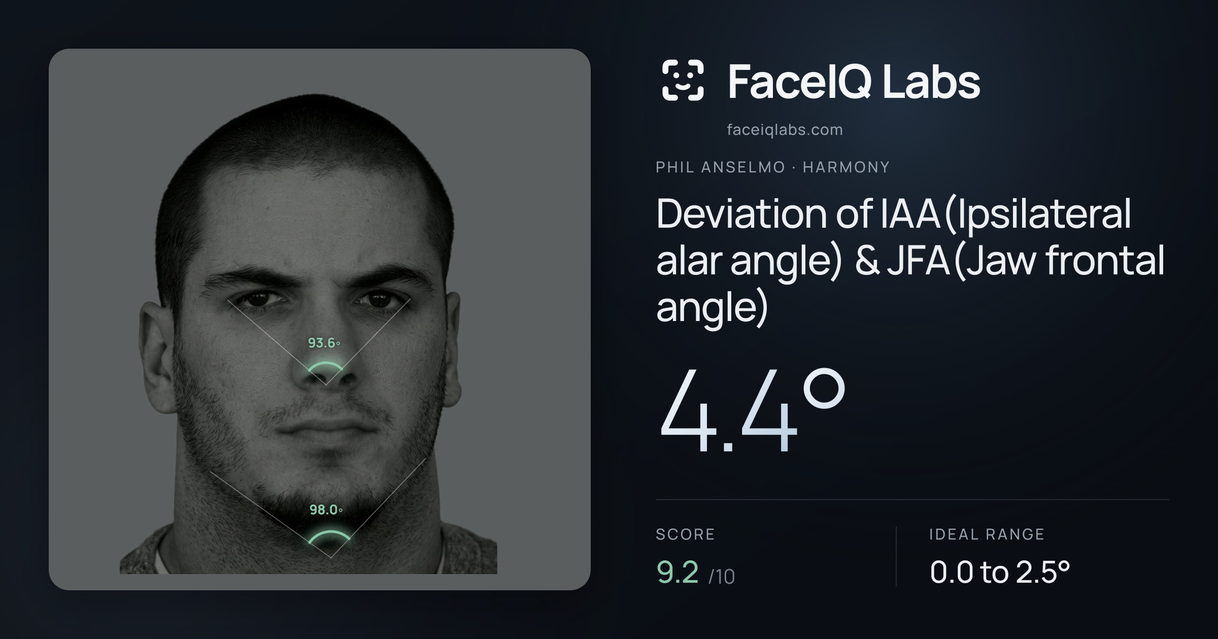 Phil Anselmo Deviation of IAA(Ipsilateral alar angle) & JFA(Jaw frontal angle): 4.4°, drawn on the photo
