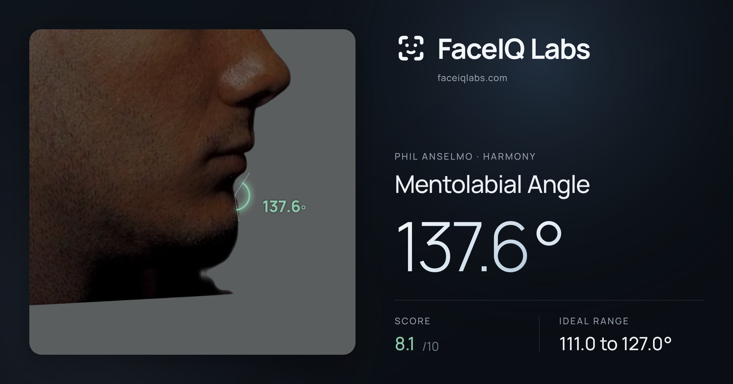 Phil Anselmo Mentolabial Angle: 137.6°, drawn on the photo