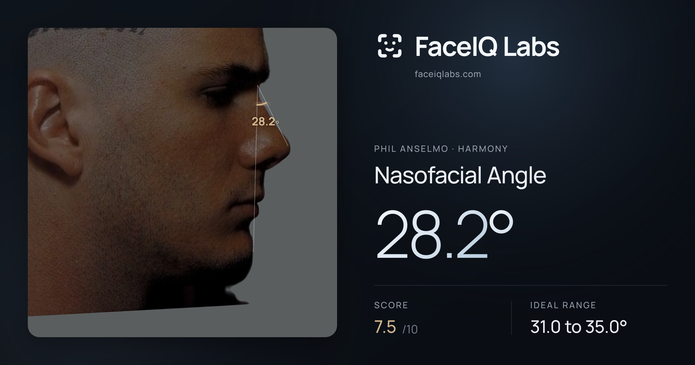 Phil Anselmo Nasofacial Angle: 28.2°, drawn on the photo