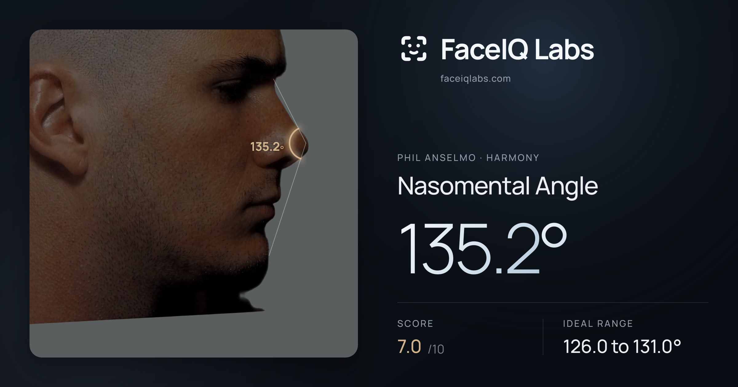 Phil Anselmo Nasomental Angle: 135.2°, drawn on the photo