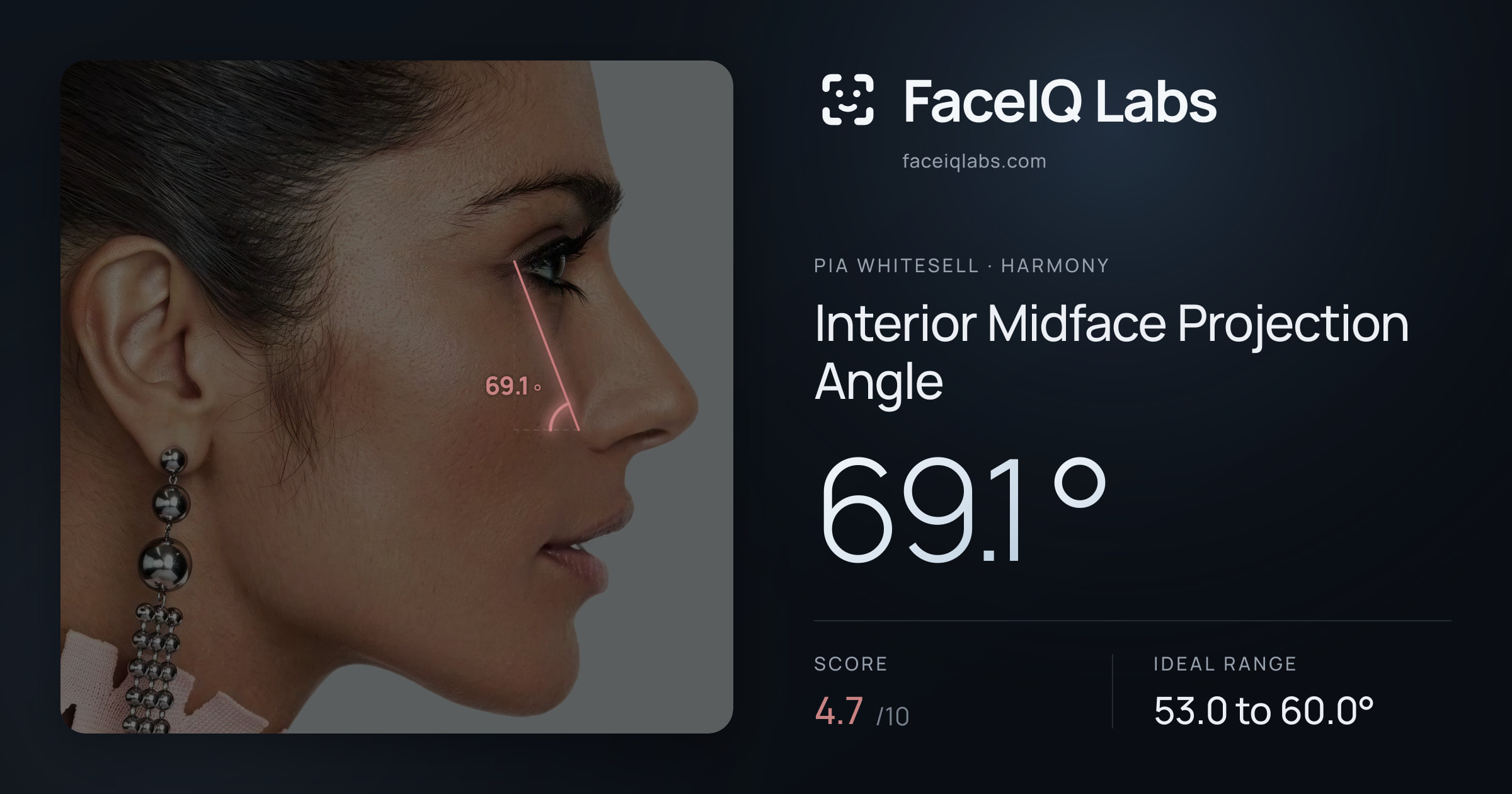 Pia Whitesell Interior Midface Projection Angle: 69.1°, drawn on the photo