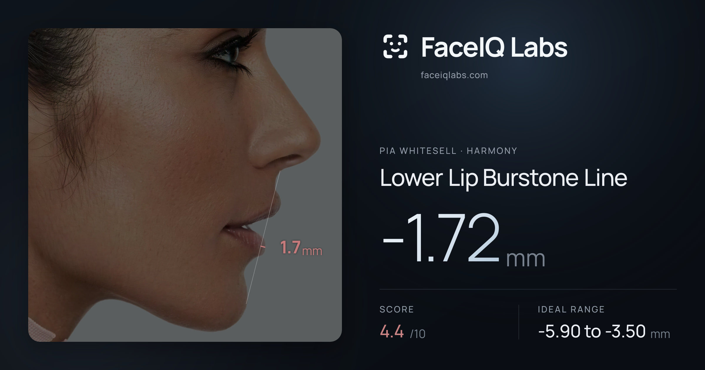 Pia Whitesell Lower Lip Burstone Line: -1.72mm, drawn on the photo