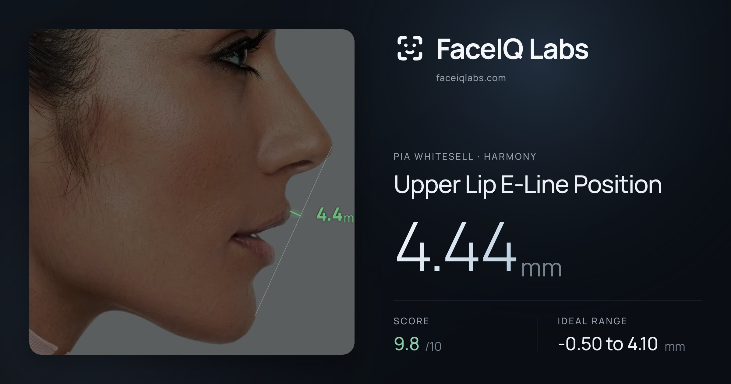 Pia Whitesell Upper Lip E-Line Position: 4.44mm, drawn on the photo