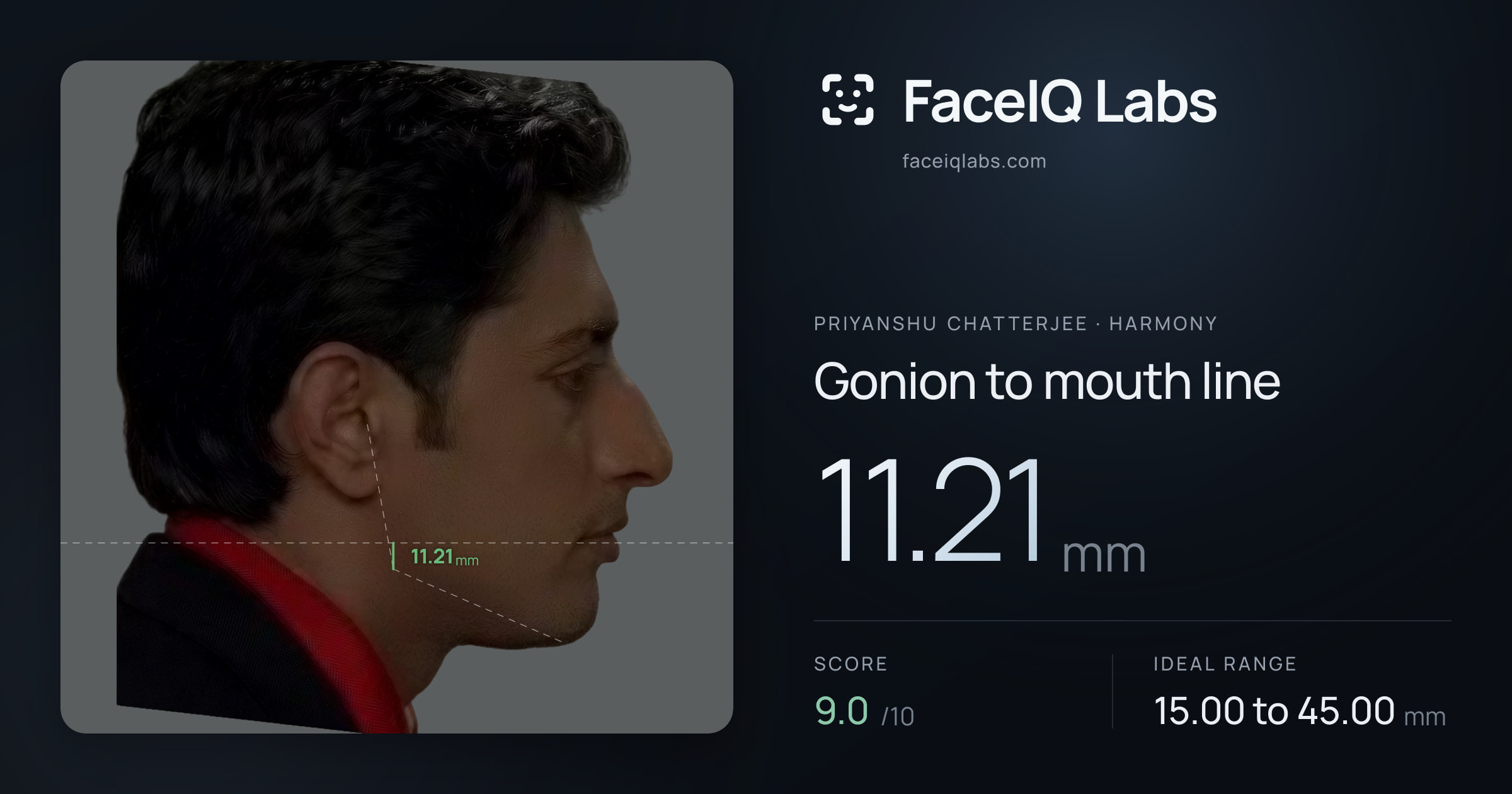 Priyanshu Chatterjee Gonion to mouth line: 11.21mm, drawn on the photo
