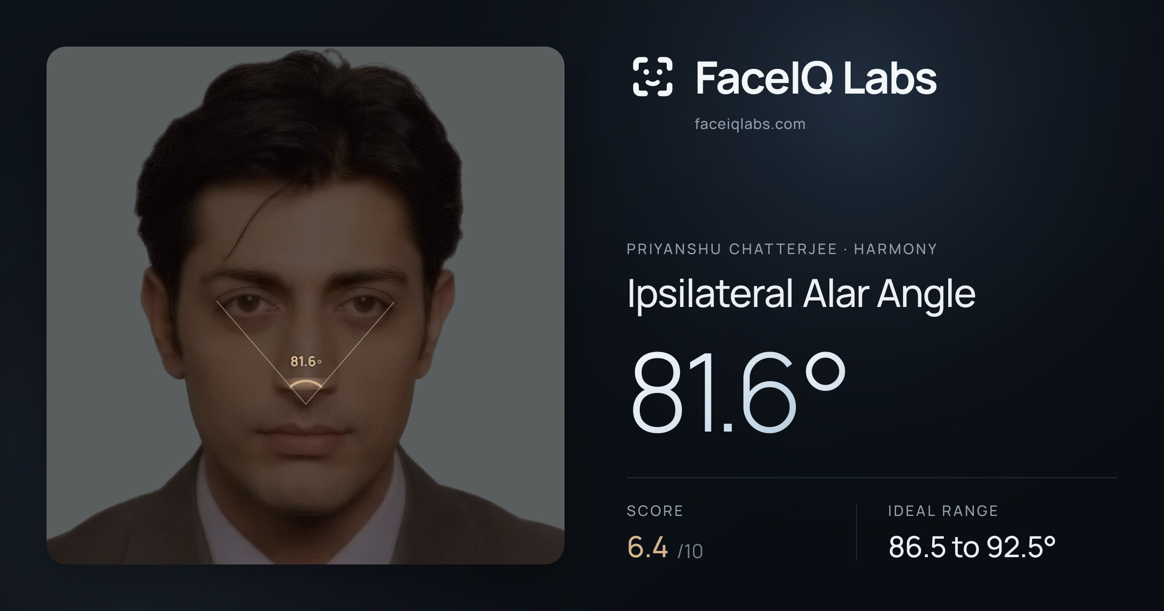 Priyanshu Chatterjee Ipsilateral Alar Angle: 81.6°, drawn on the photo