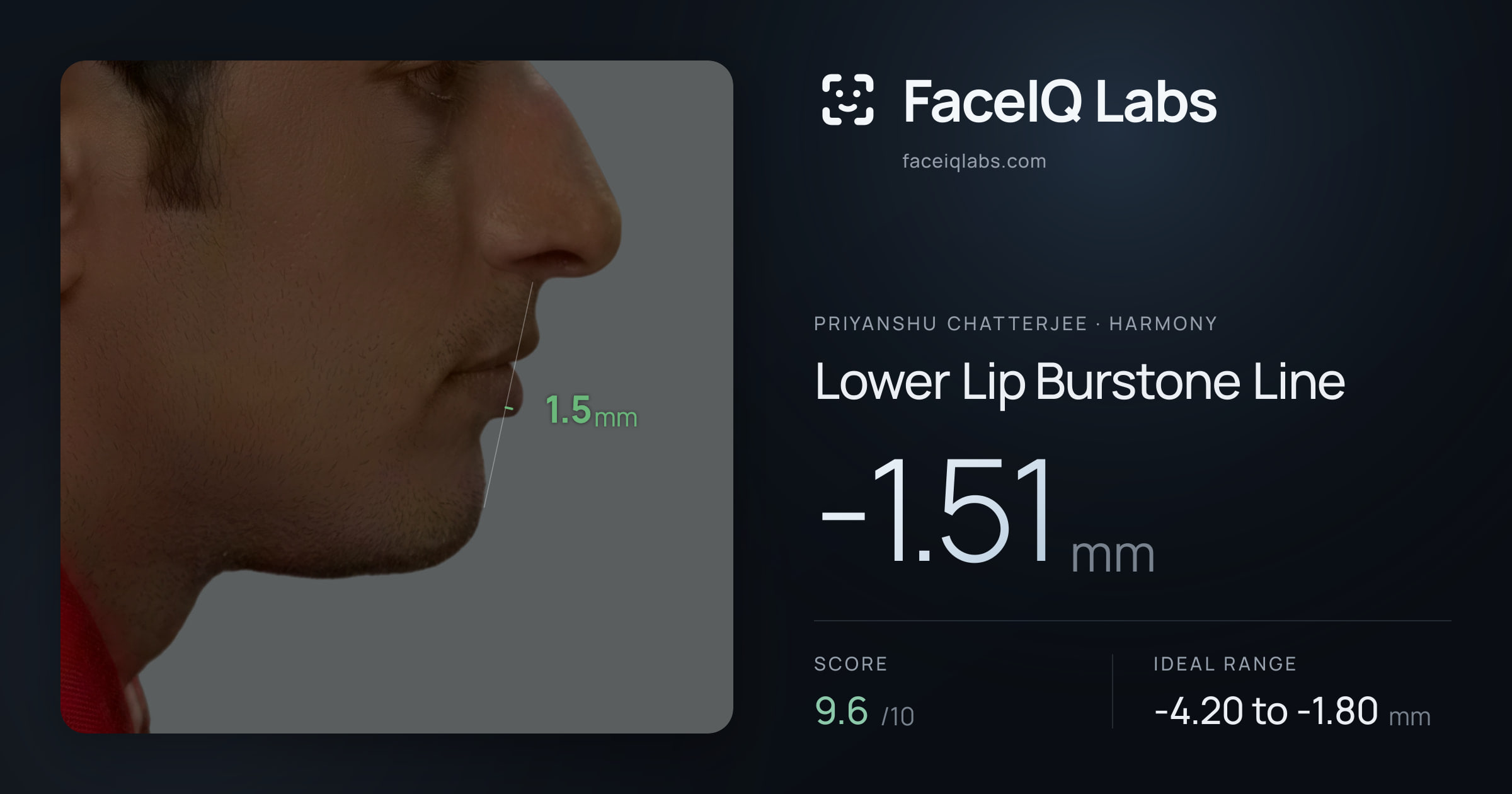 Priyanshu Chatterjee Lower Lip Burstone Line: -1.51mm, drawn on the photo