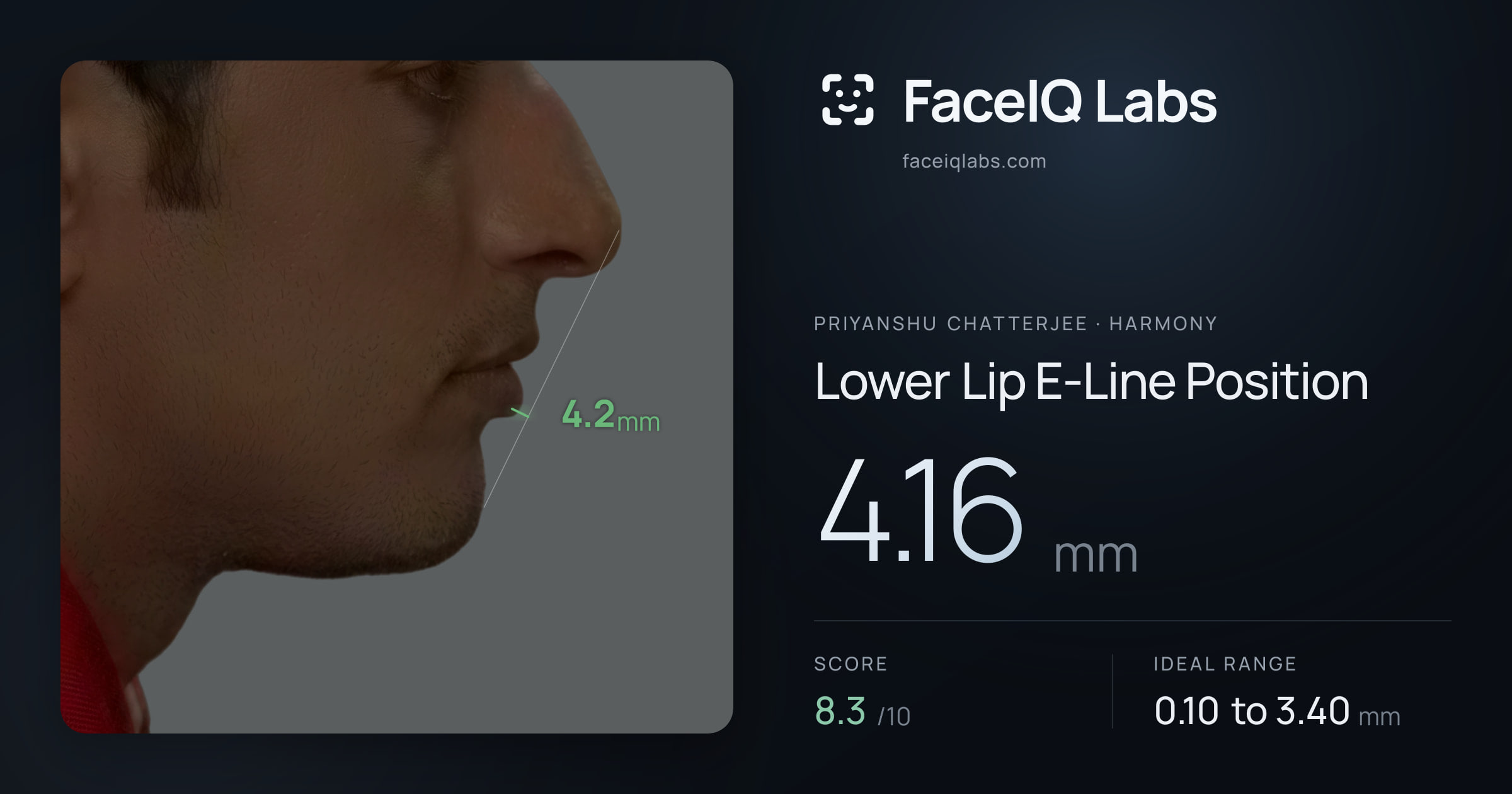 Priyanshu Chatterjee Lower Lip E-Line Position: 4.16mm, drawn on the photo