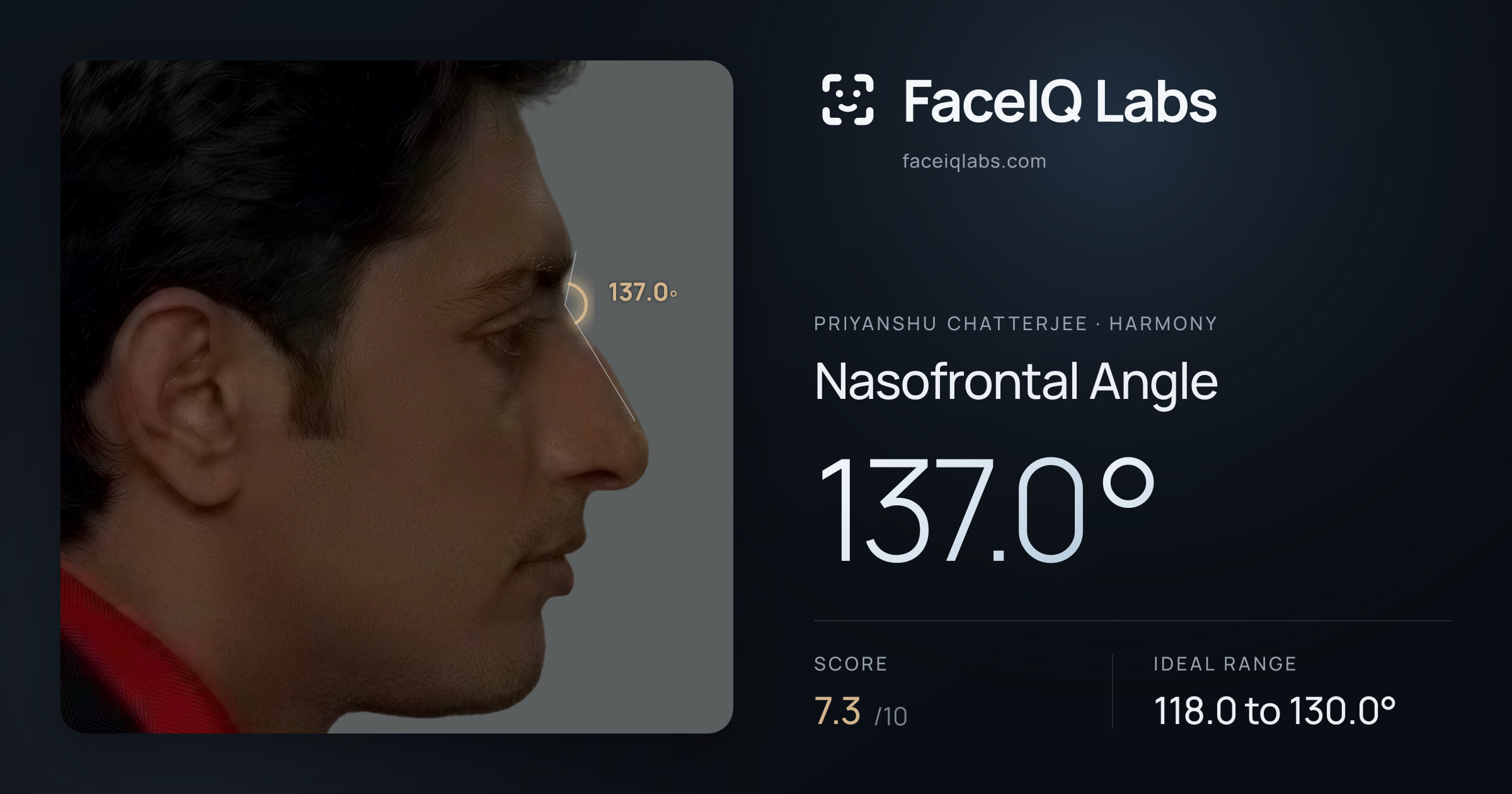 Priyanshu Chatterjee Nasofrontal Angle: 137.0°, drawn on the photo