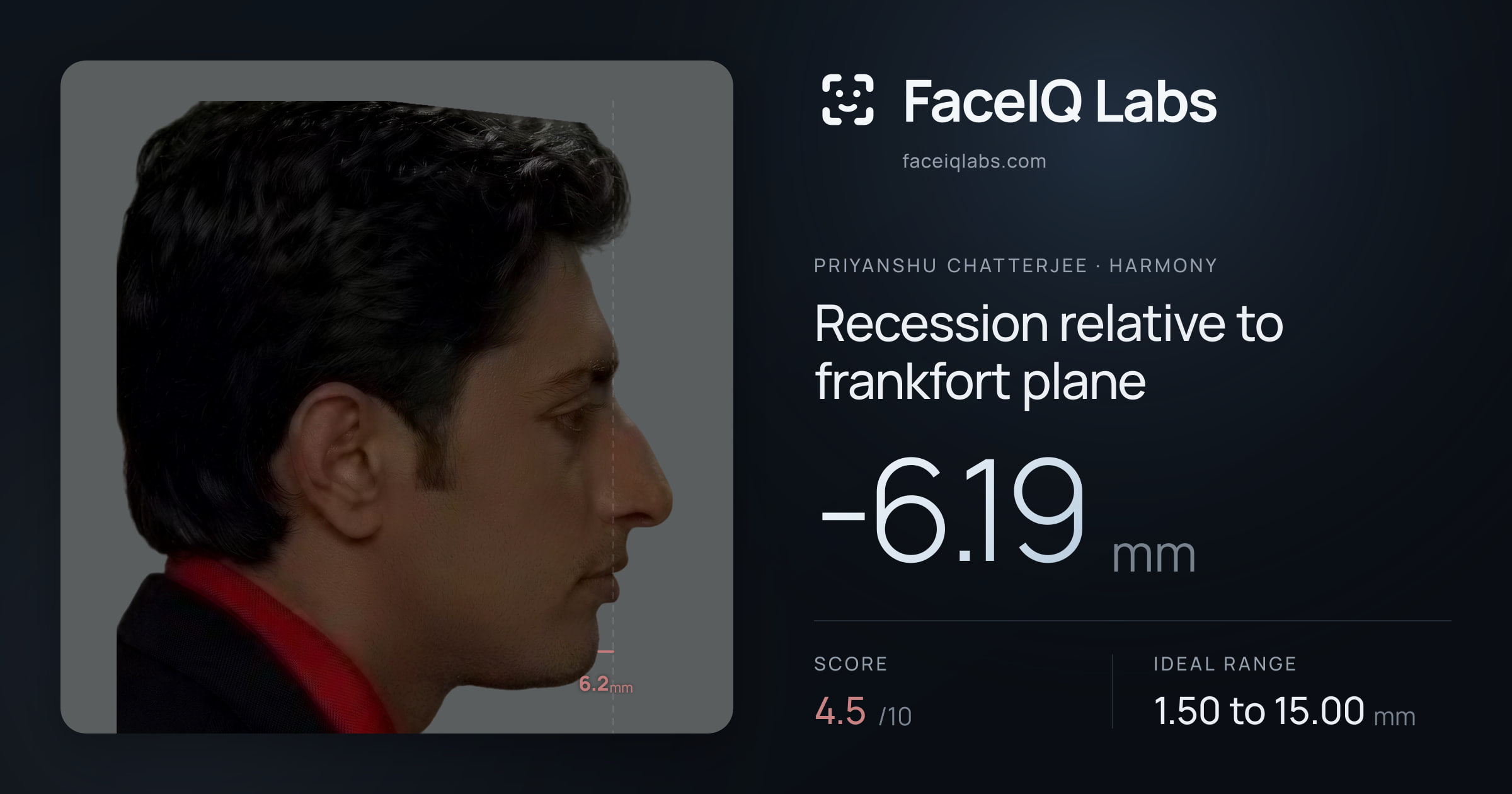 Priyanshu Chatterjee Recession relative to frankfort plane: -6.19mm, drawn on the photo