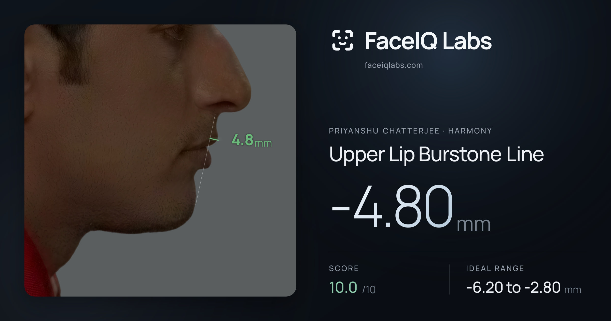 Priyanshu Chatterjee Upper Lip Burstone Line: -4.80mm, drawn on the photo