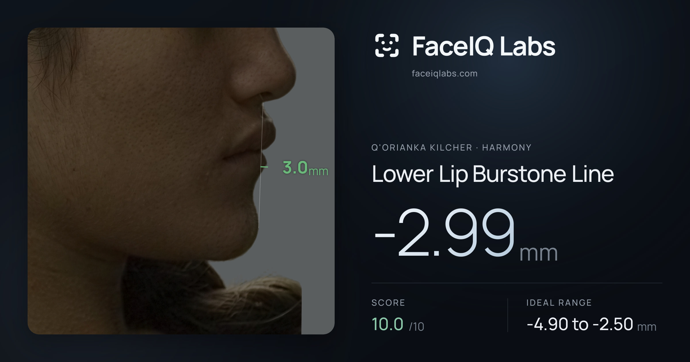 Q'orianka Kilcher Lower Lip Burstone Line: -2.99mm, drawn on the photo
