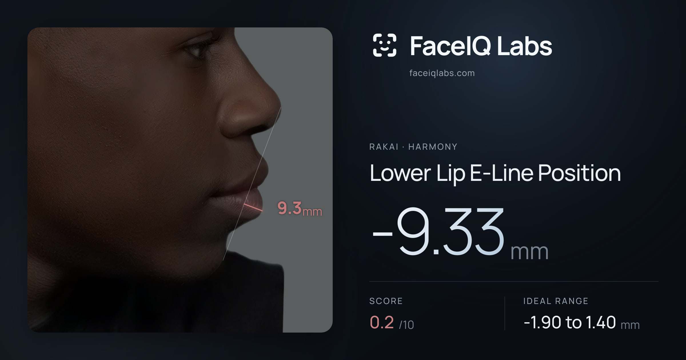 Rakai Lower Lip E-Line Position: -9.33mm, drawn on the photo