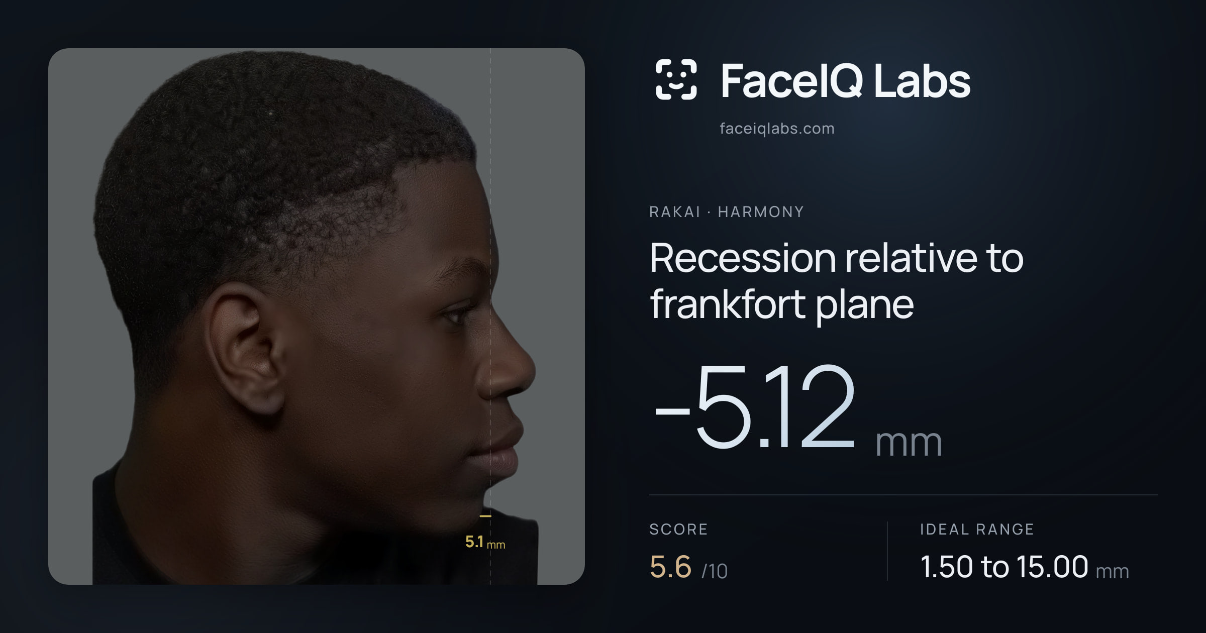 Rakai Recession relative to frankfort plane: -5.12mm, drawn on the photo