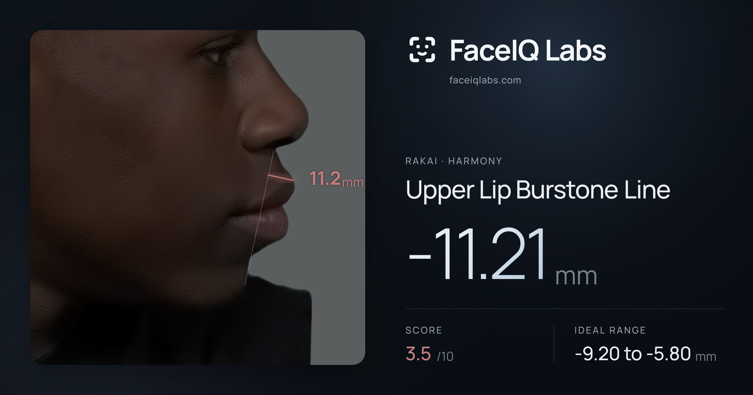Rakai Upper Lip Burstone Line: -11.21mm, drawn on the photo
