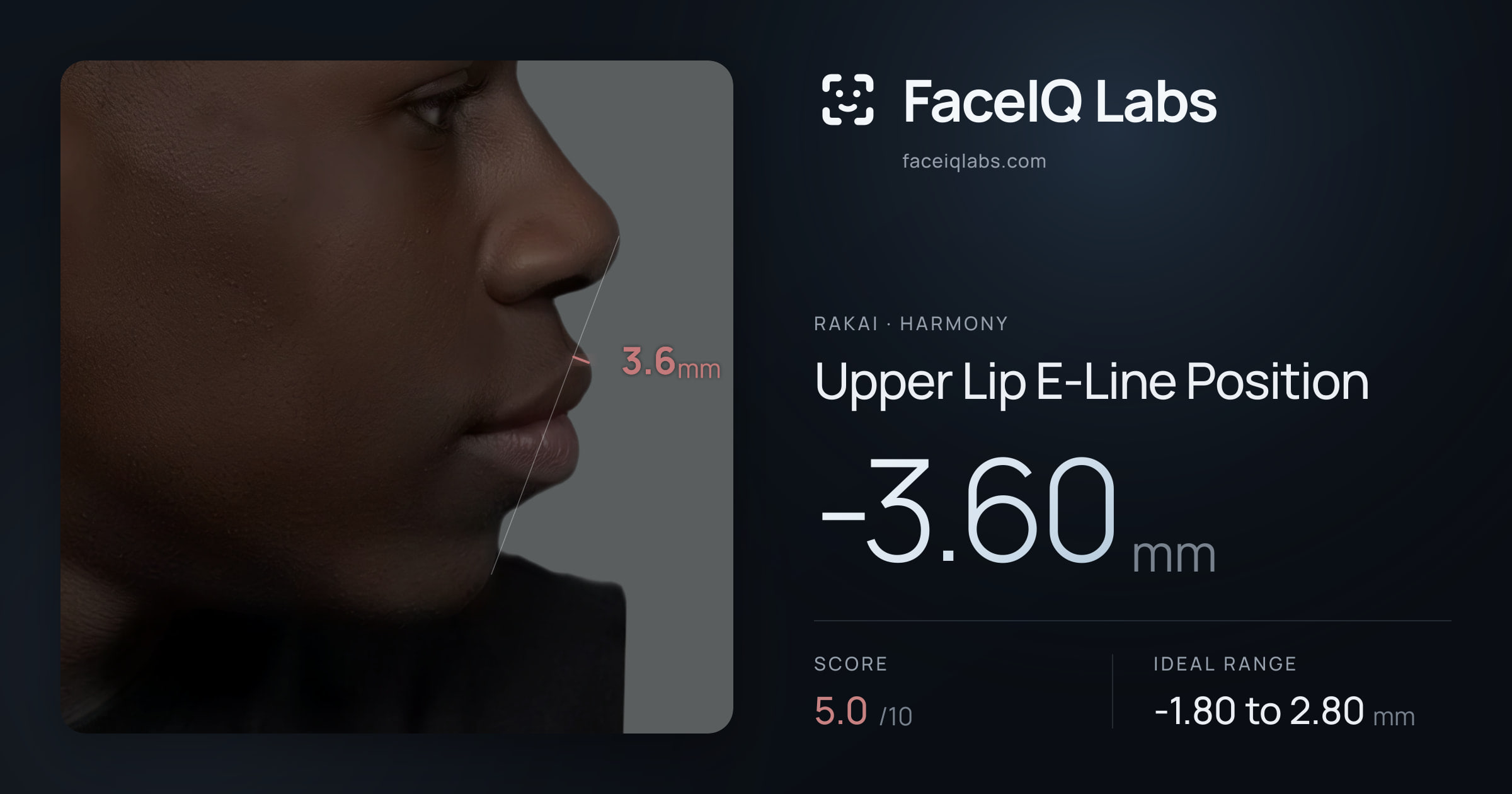 Rakai Upper Lip E-Line Position: -3.60mm, drawn on the photo