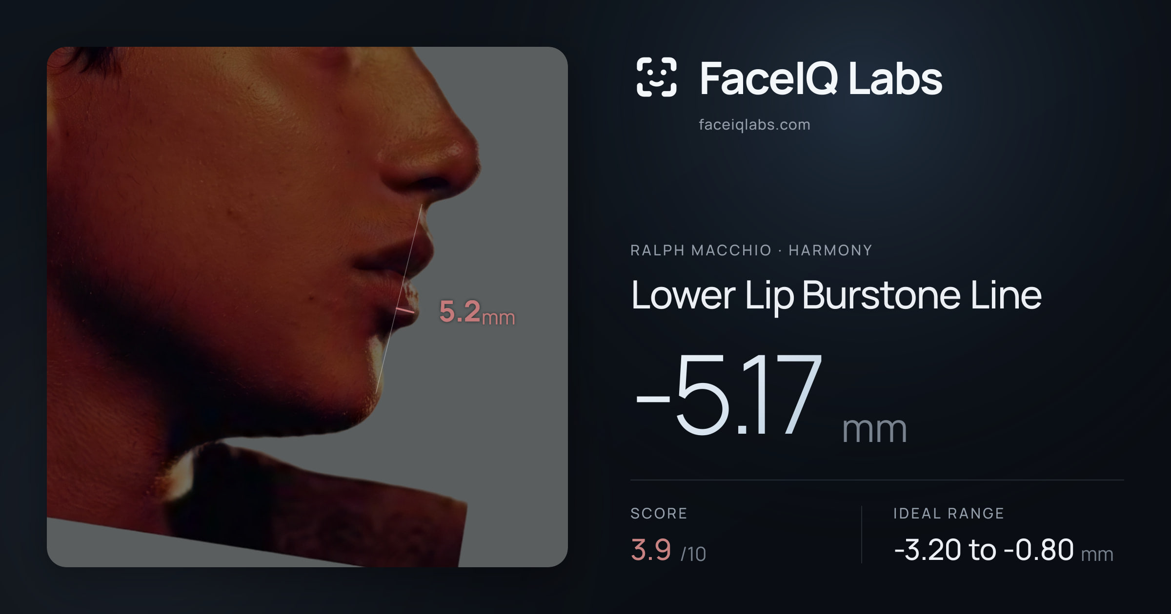 Ralph Macchio Lower Lip Burstone Line: -5.17mm, drawn on the photo