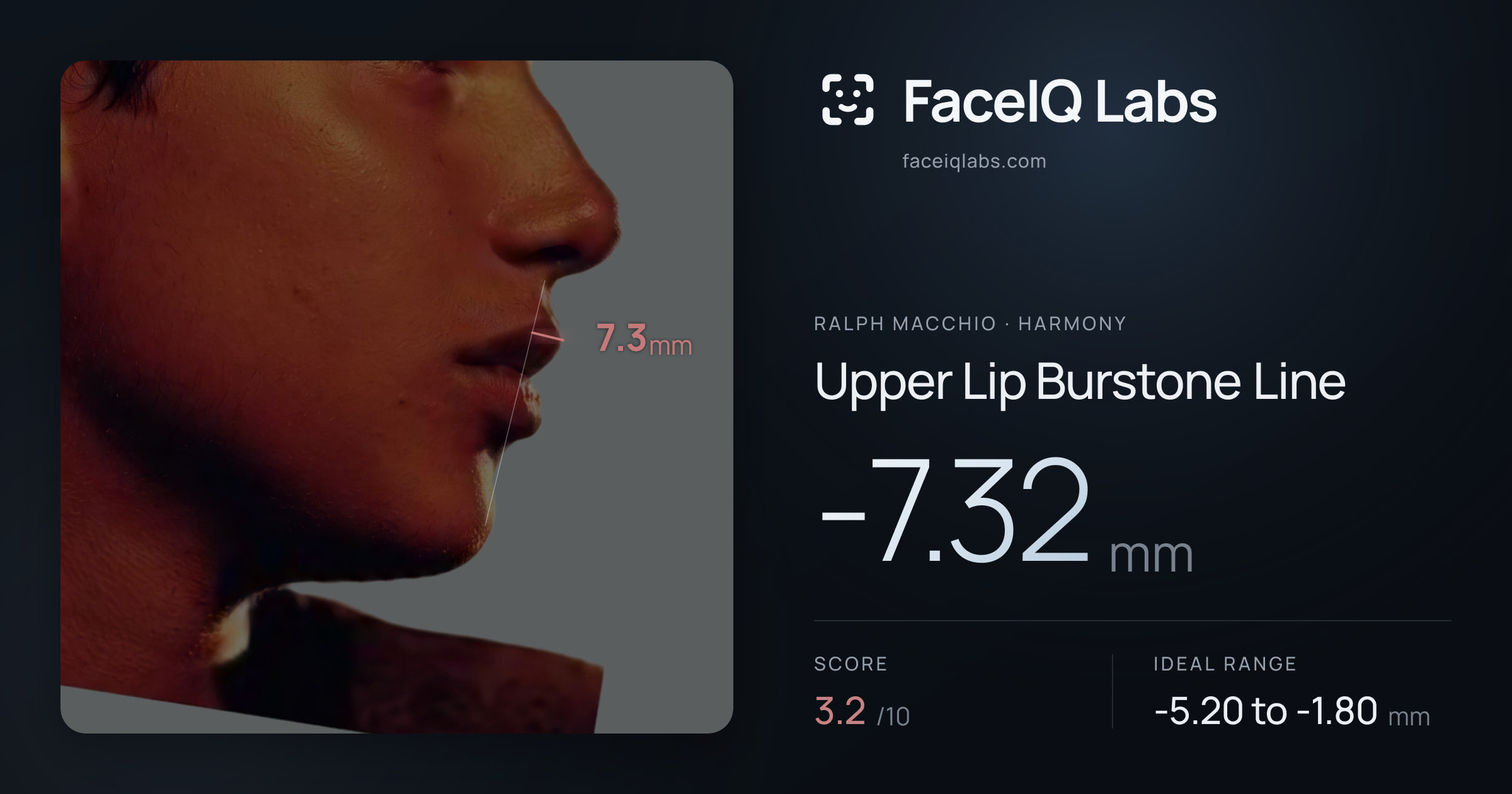 Ralph Macchio Upper Lip Burstone Line: -7.32mm, drawn on the photo