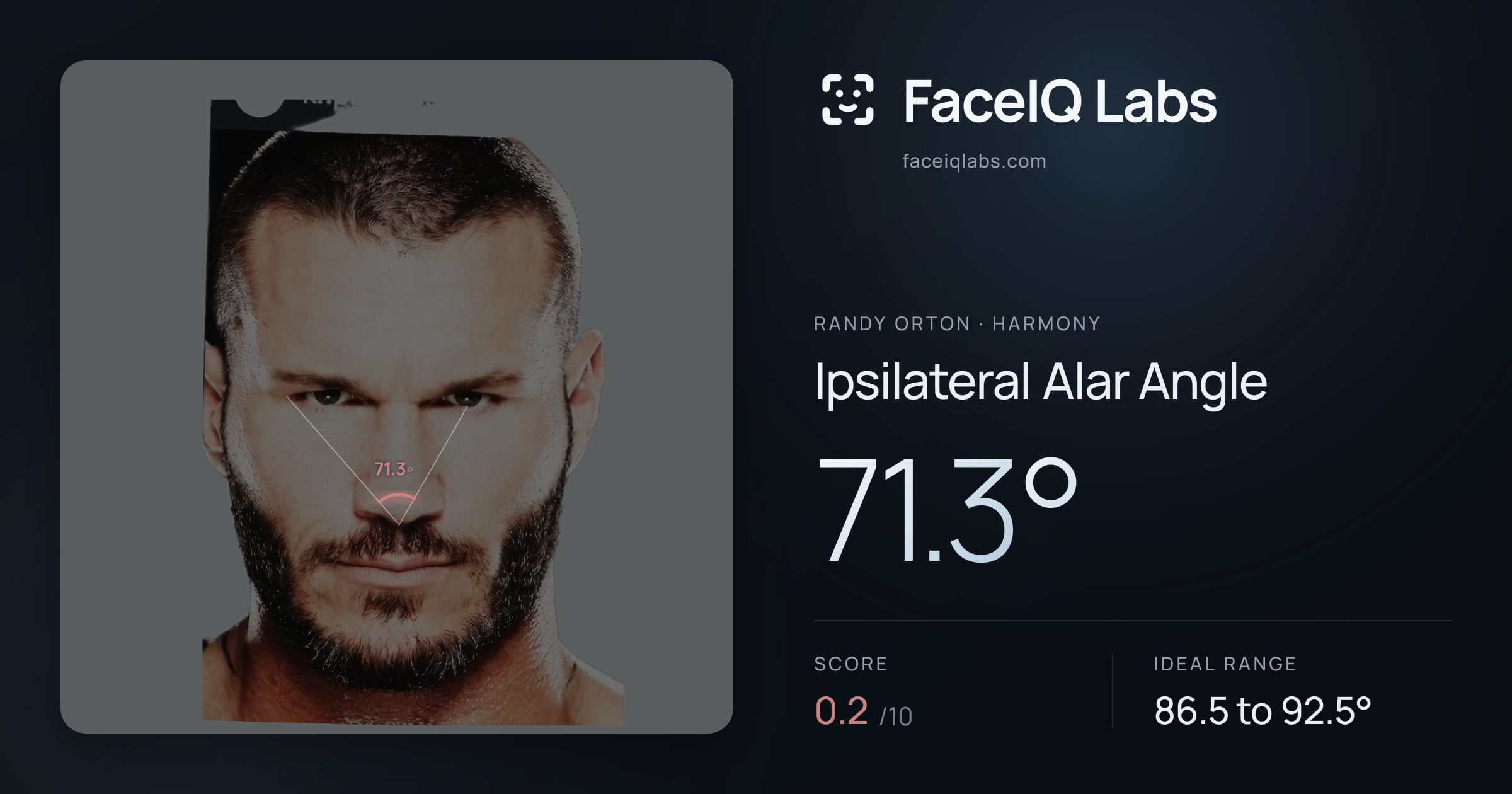 Randy Orton Ipsilateral Alar Angle: 71.3°, drawn on the photo