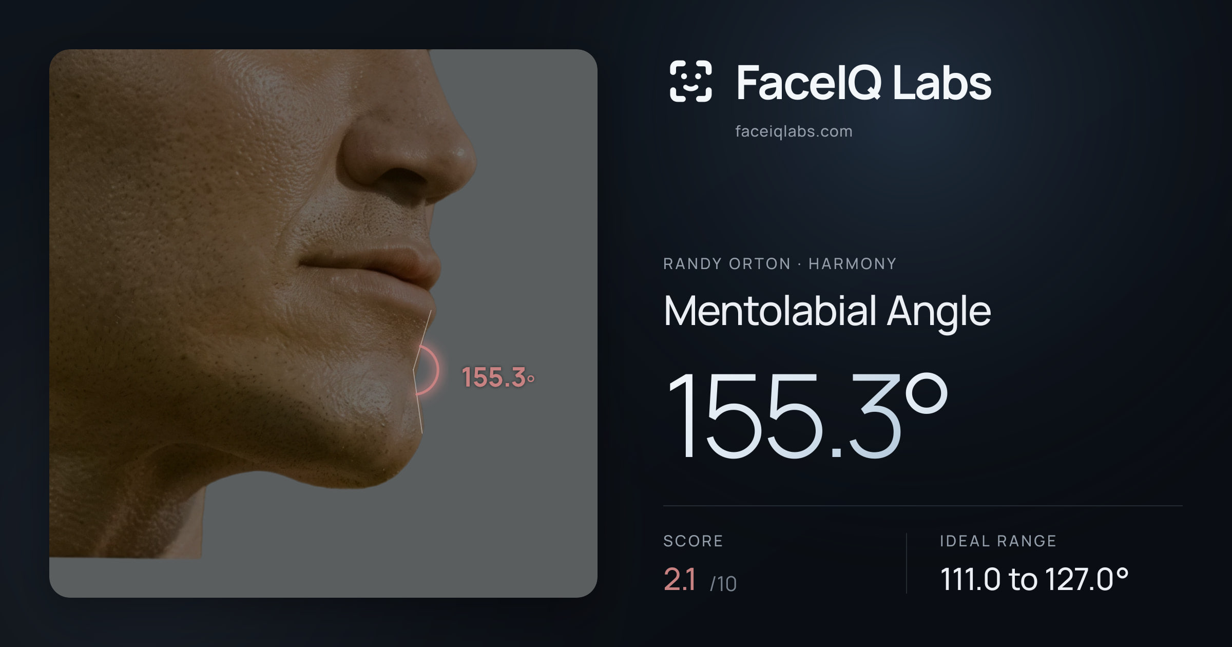 Randy Orton Mentolabial Angle: 155.3°, drawn on the photo