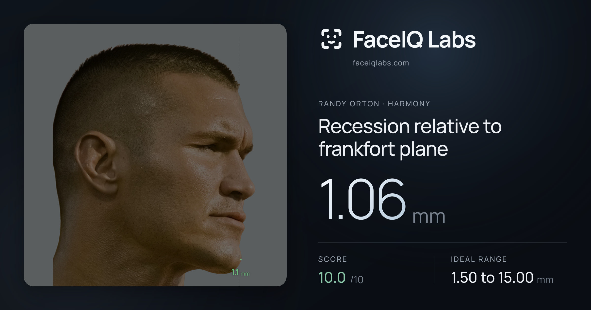 Randy Orton Recession relative to frankfort plane: 1.06mm, drawn on the photo
