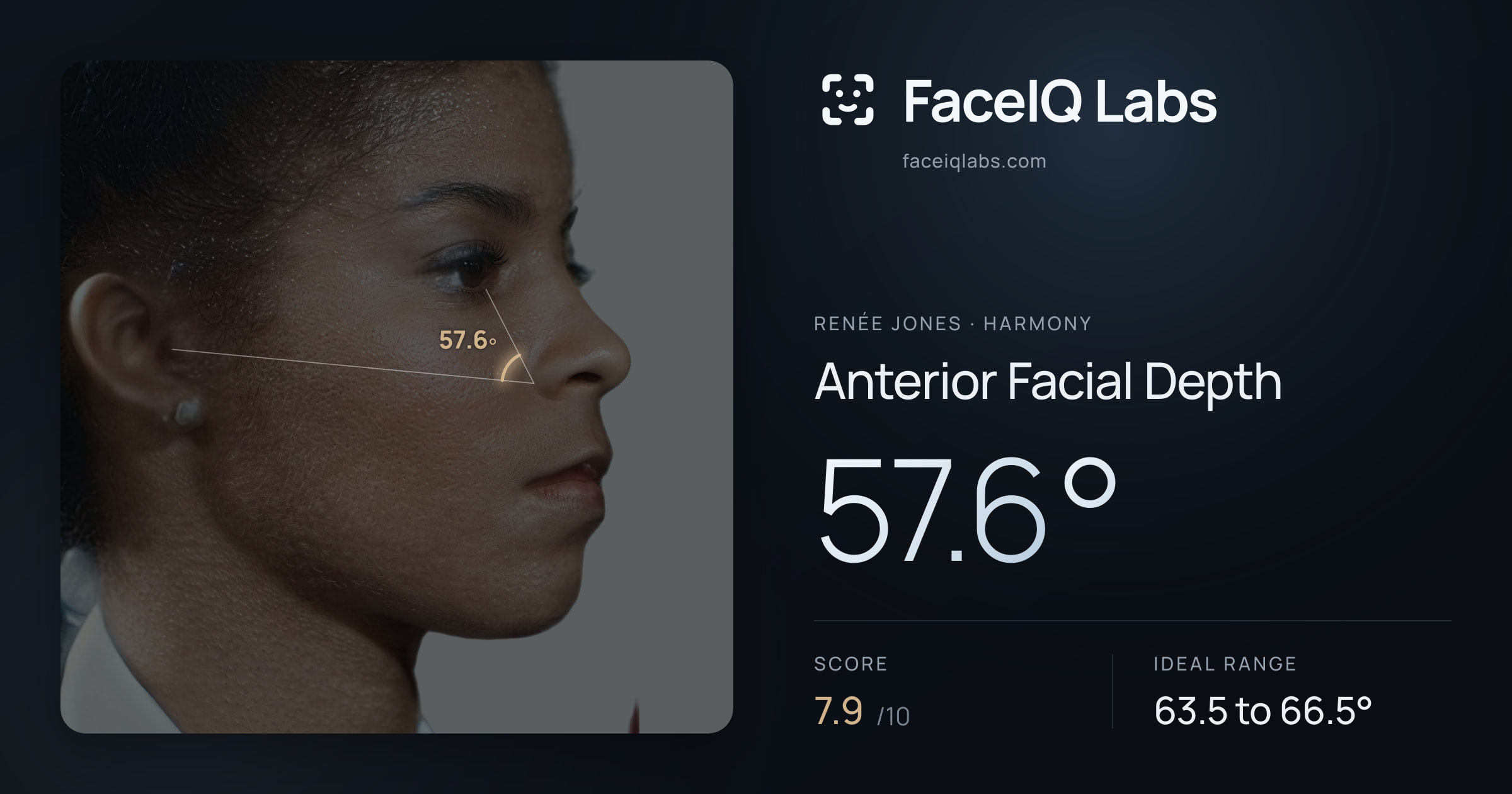 Renée Jones Anterior Facial Depth: 57.6°, drawn on the photo
