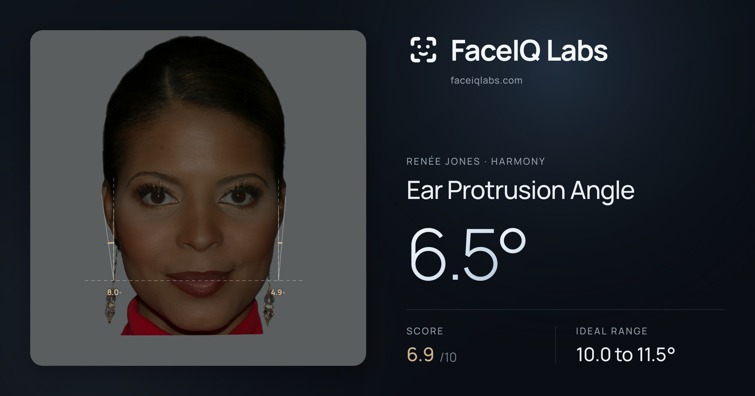 Renée Jones Ear Protrusion Angle: 6.5°, drawn on the photo