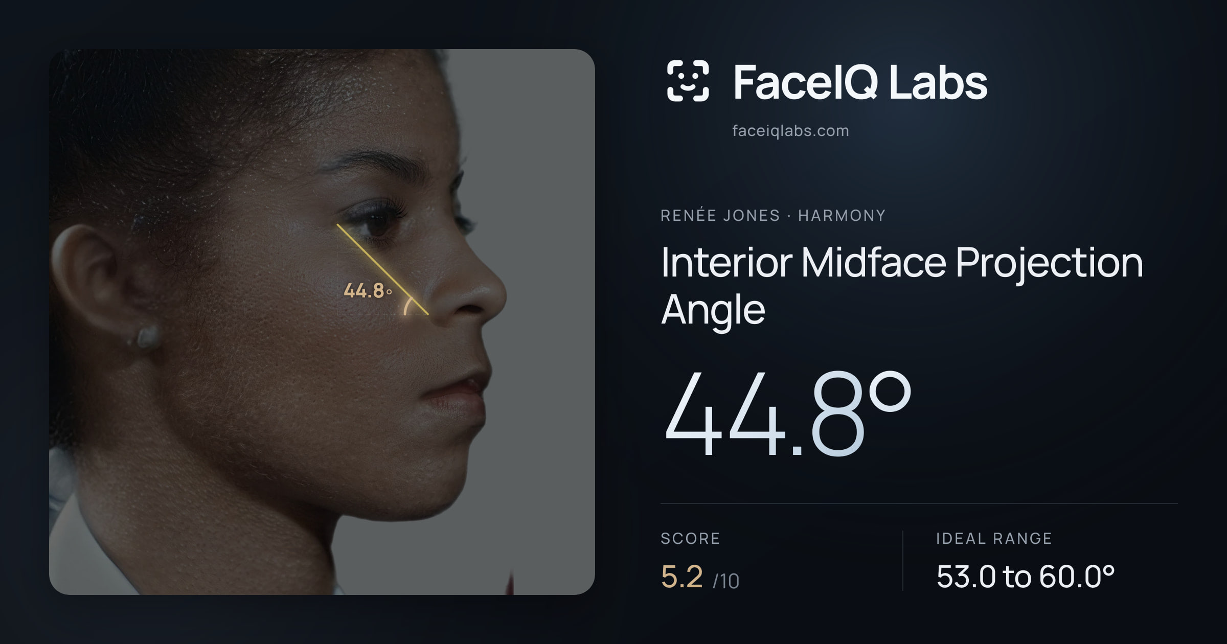 Renée Jones Interior Midface Projection Angle: 44.8°, drawn on the photo