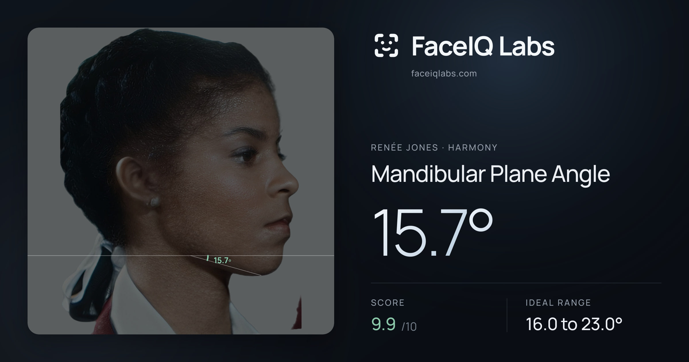 Renée Jones Mandibular Plane Angle: 15.7°, drawn on the photo