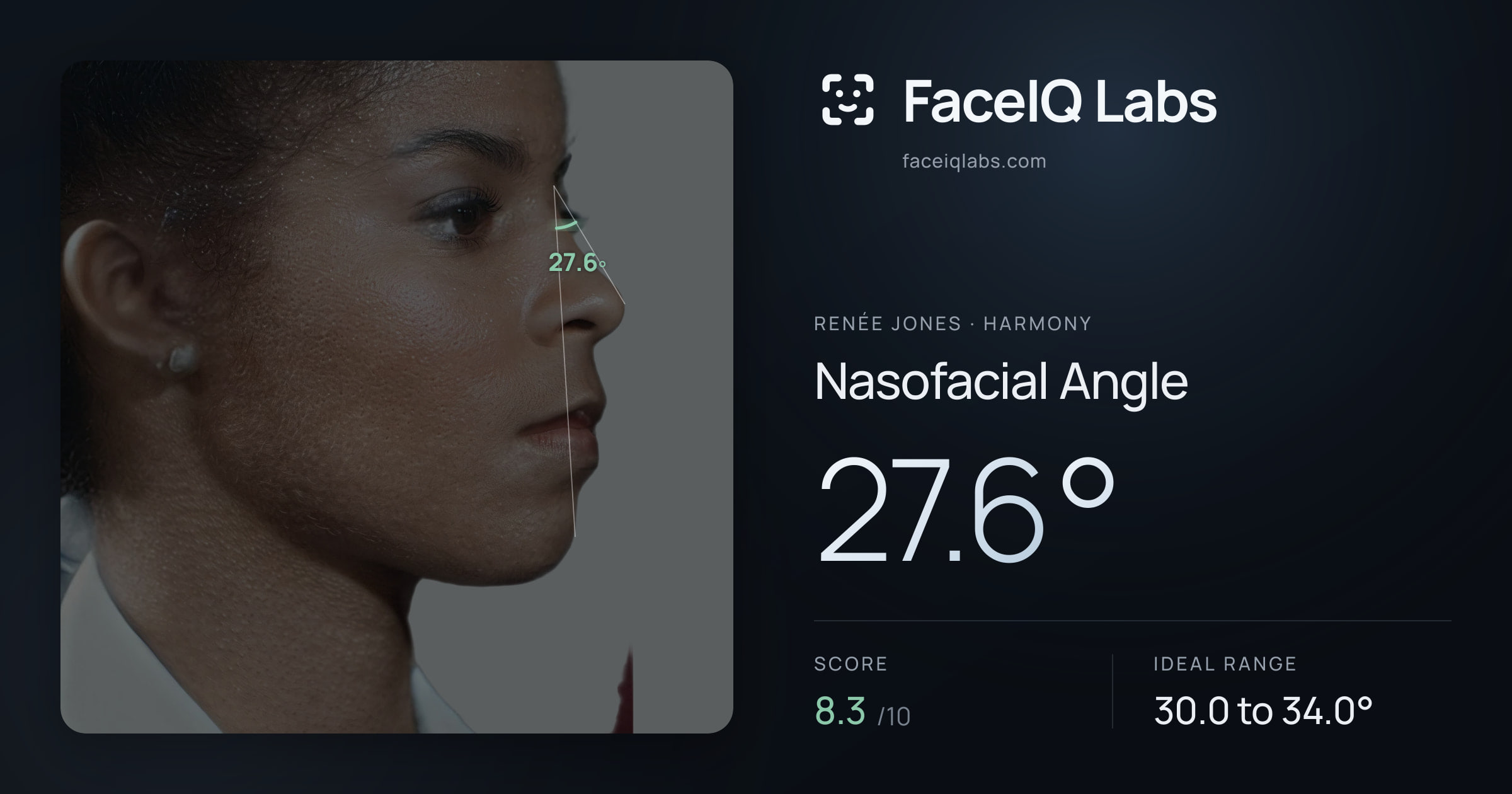 Renée Jones Nasofacial Angle: 27.6°, drawn on the photo