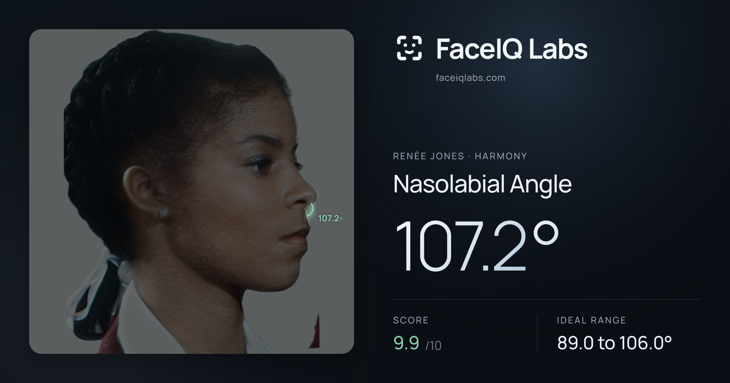 Renée Jones Nasolabial Angle: 107.2°, drawn on the photo
