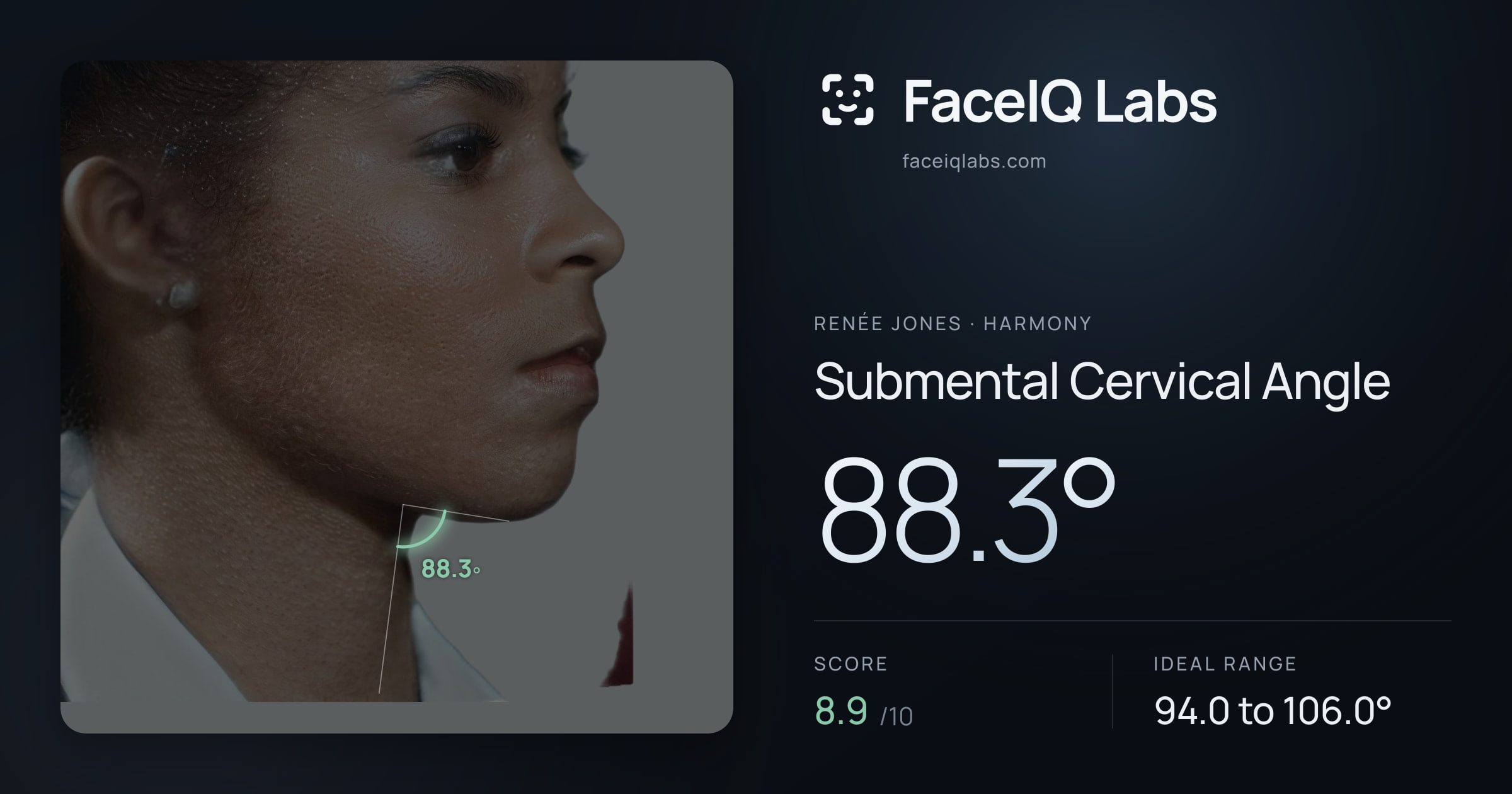Renée Jones Submental Cervical Angle: 88.3°, drawn on the photo
