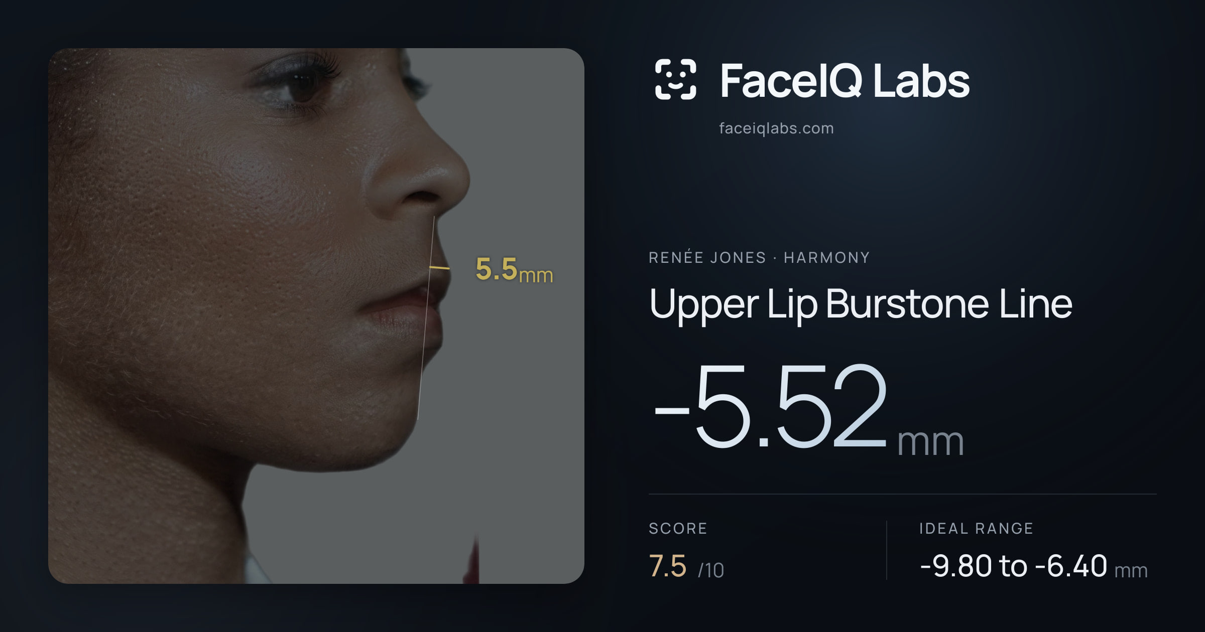 Renée Jones Upper Lip Burstone Line: -5.52mm, drawn on the photo