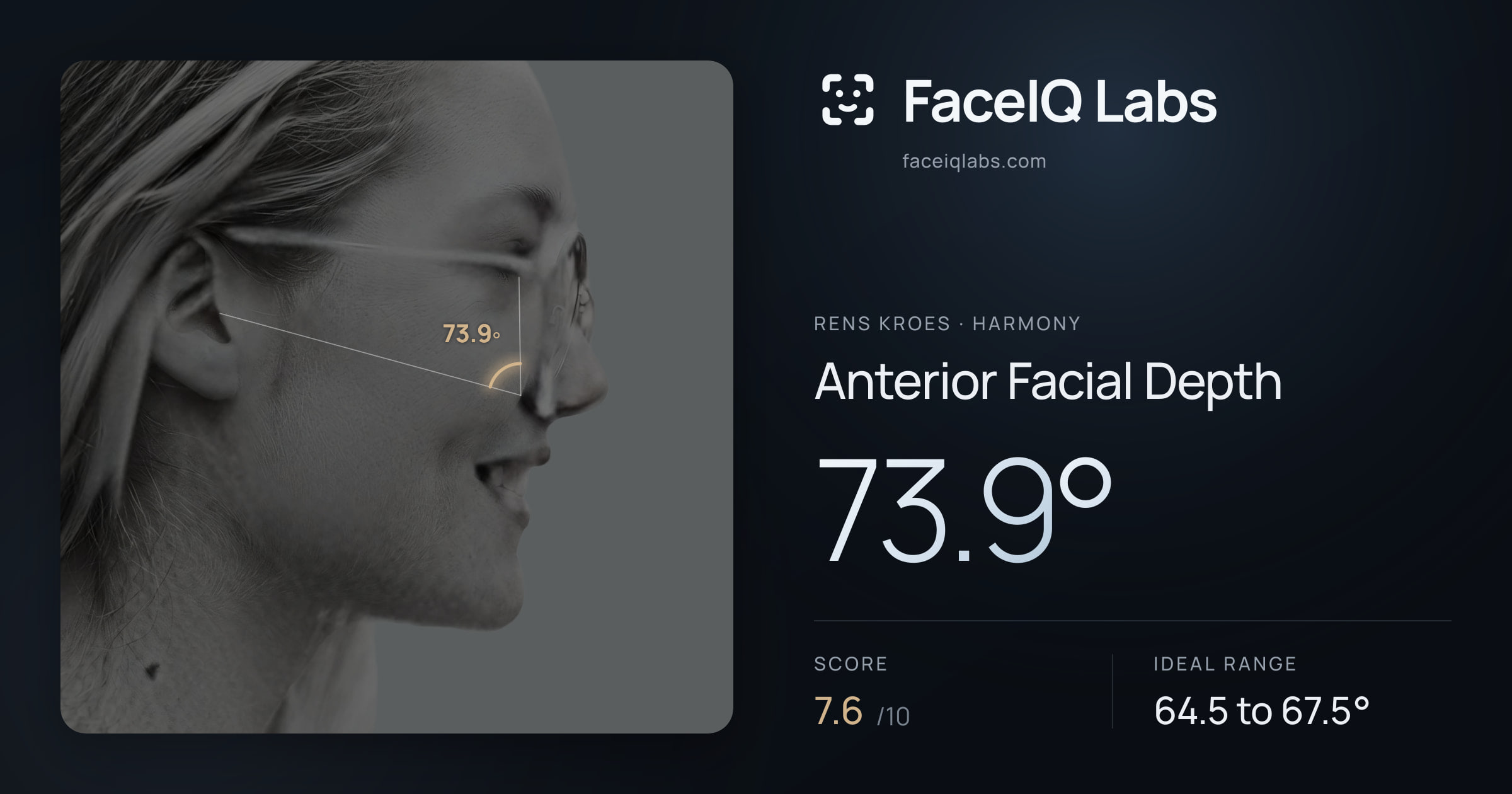Rens Kroes Anterior Facial Depth: 73.9°, drawn on the photo