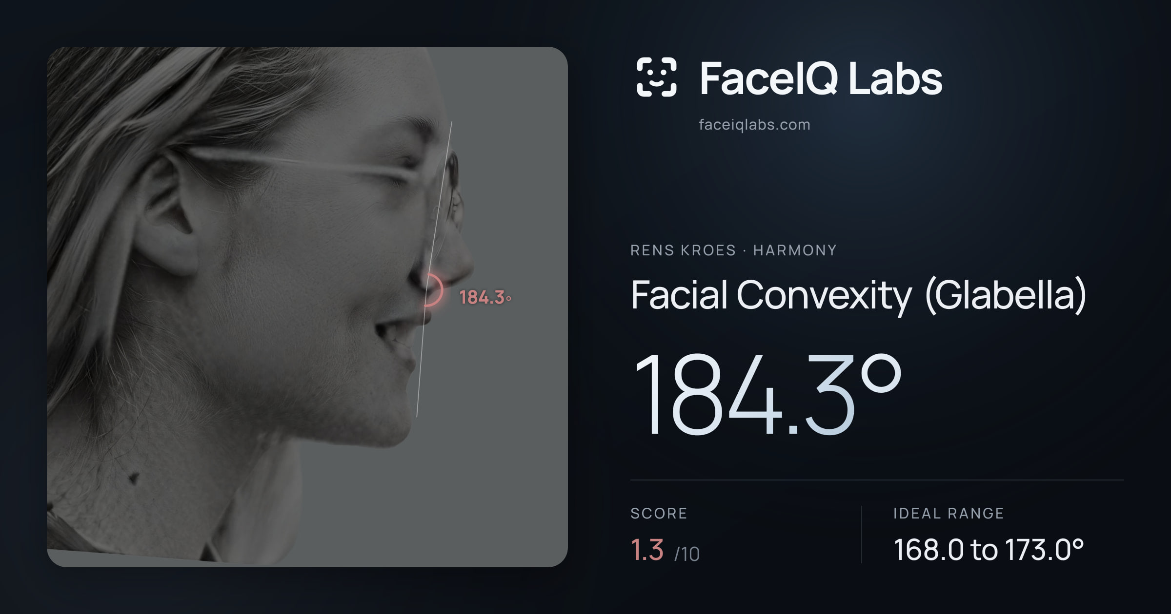 Rens Kroes Facial Convexity (Glabella): 184.3°, drawn on the photo