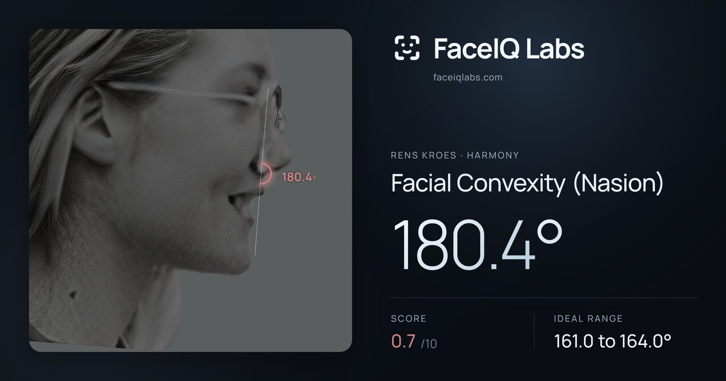 Rens Kroes Facial Convexity (Nasion): 180.4°, drawn on the photo