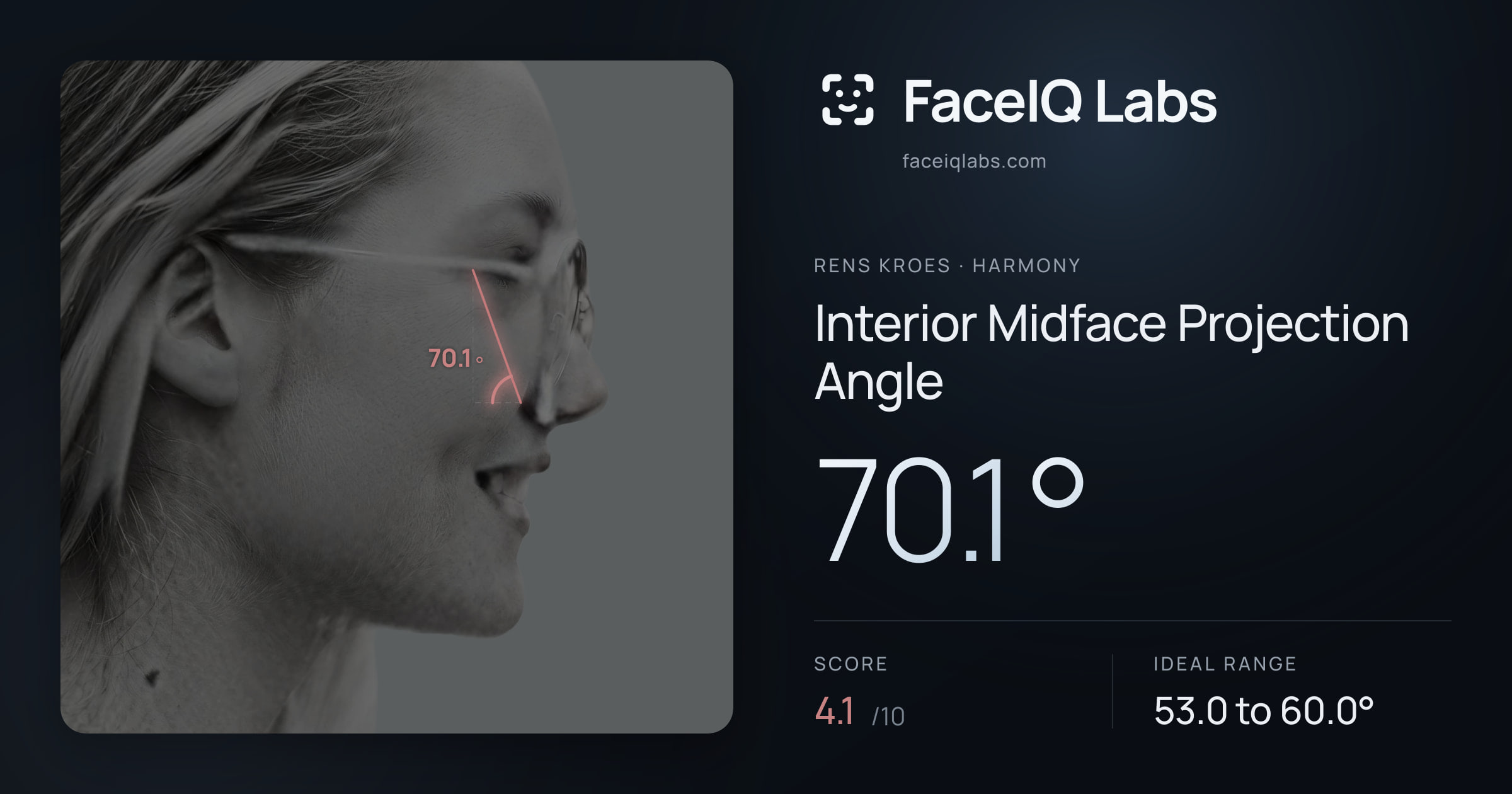 Rens Kroes Interior Midface Projection Angle: 70.1°, drawn on the photo