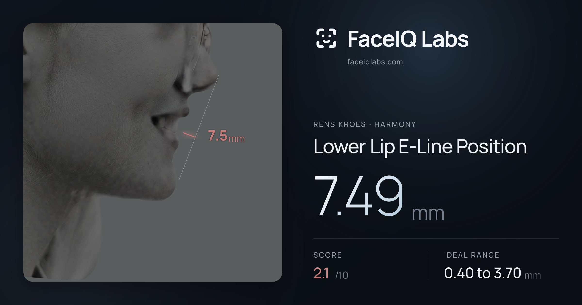 Rens Kroes Lower Lip E-Line Position: 7.49mm, drawn on the photo