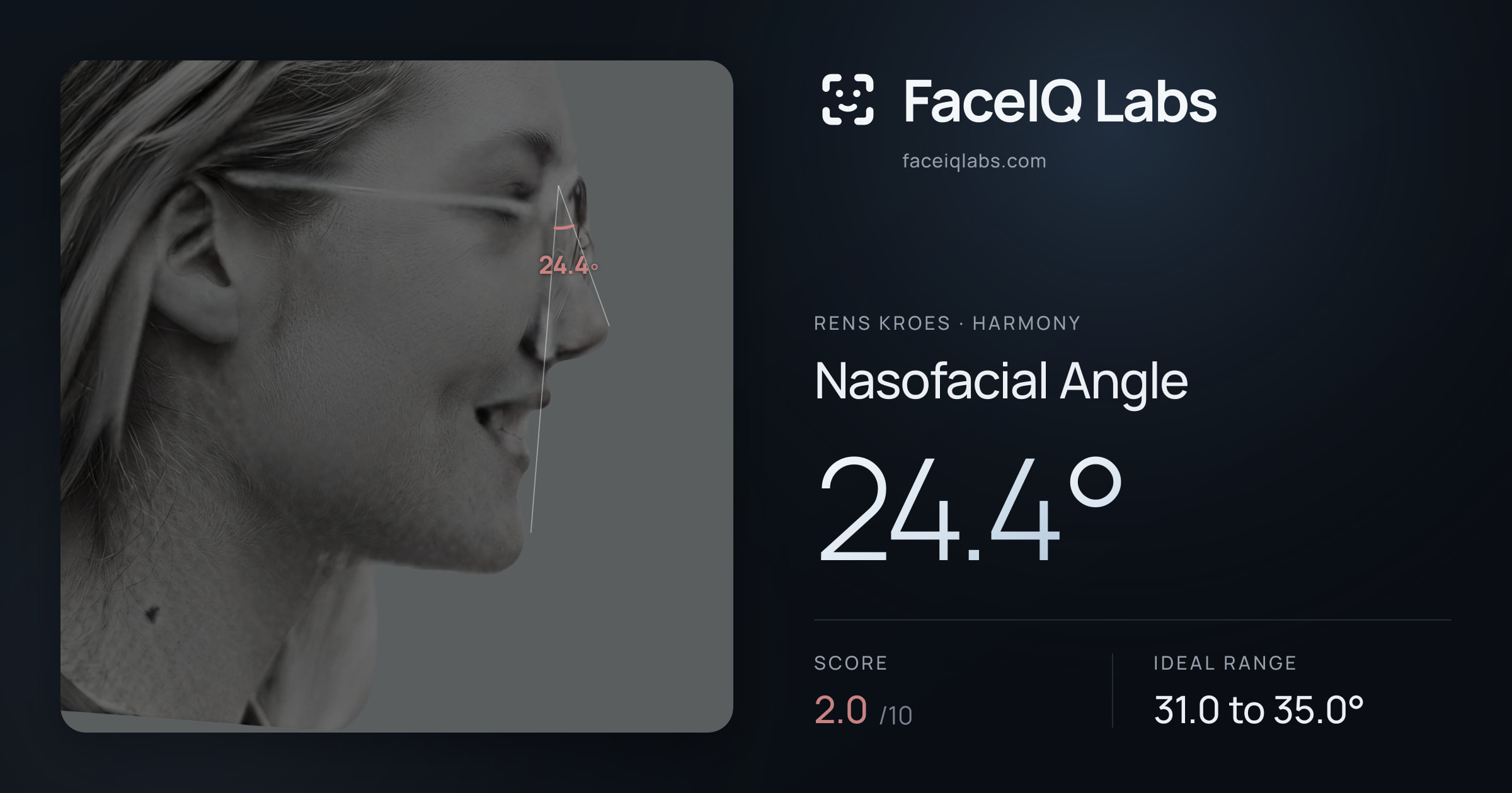 Rens Kroes Nasofacial Angle: 24.4°, drawn on the photo