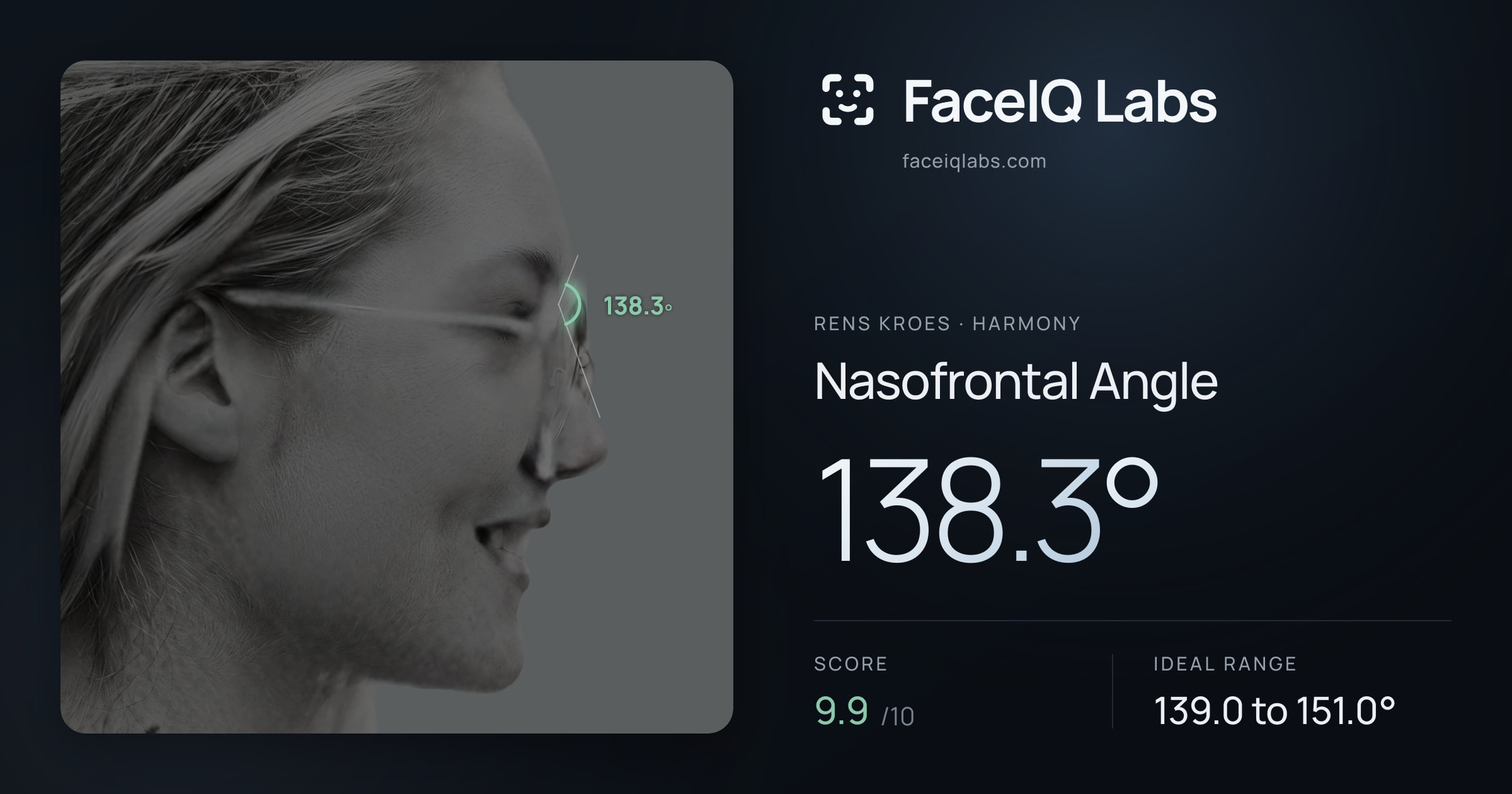Rens Kroes Nasofrontal Angle: 138.3°, drawn on the photo
